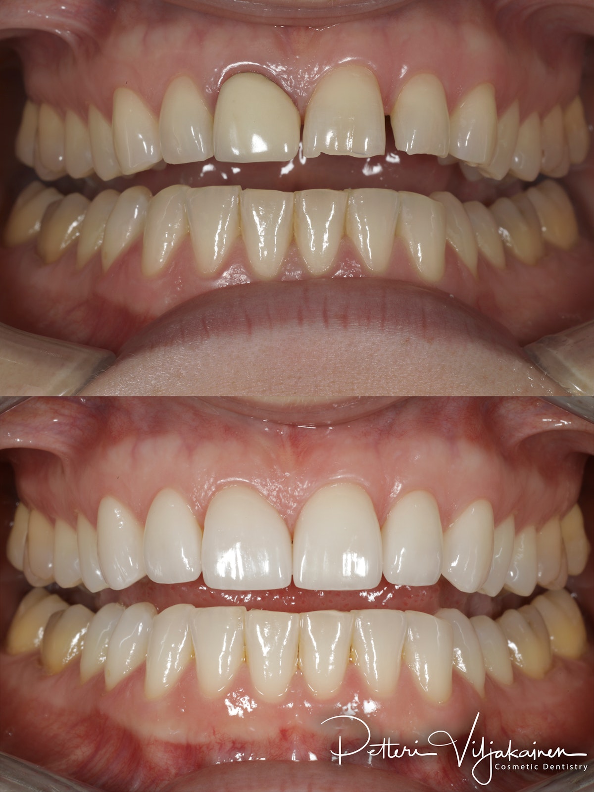 Esteettinen hammashoito ennen jälkeen. Keraamiset kuoret eli hammaslaminaatit kuudessa yläetuhampaassa.