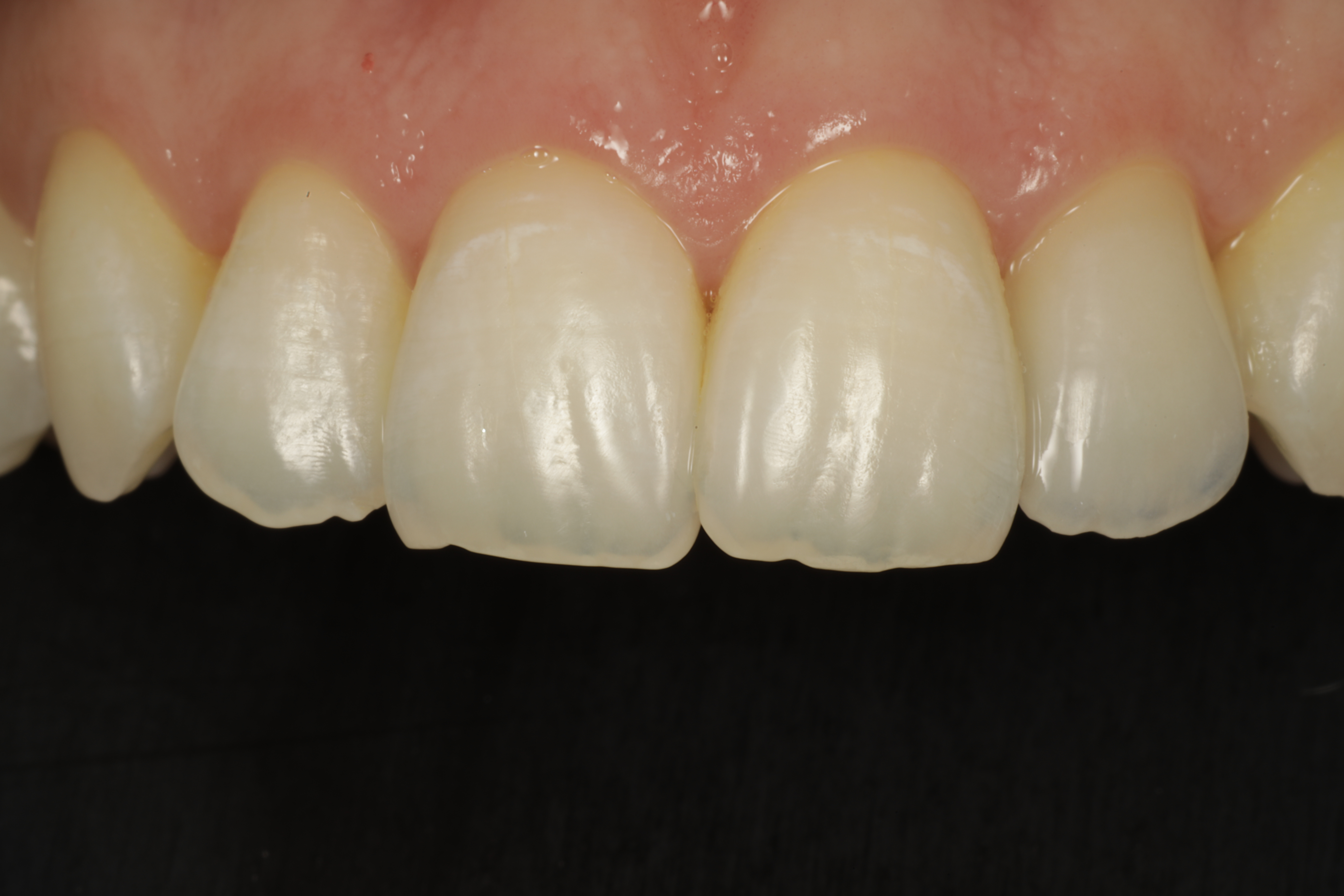 Valmis kuori eli hammaslaminaatti sementoituna.