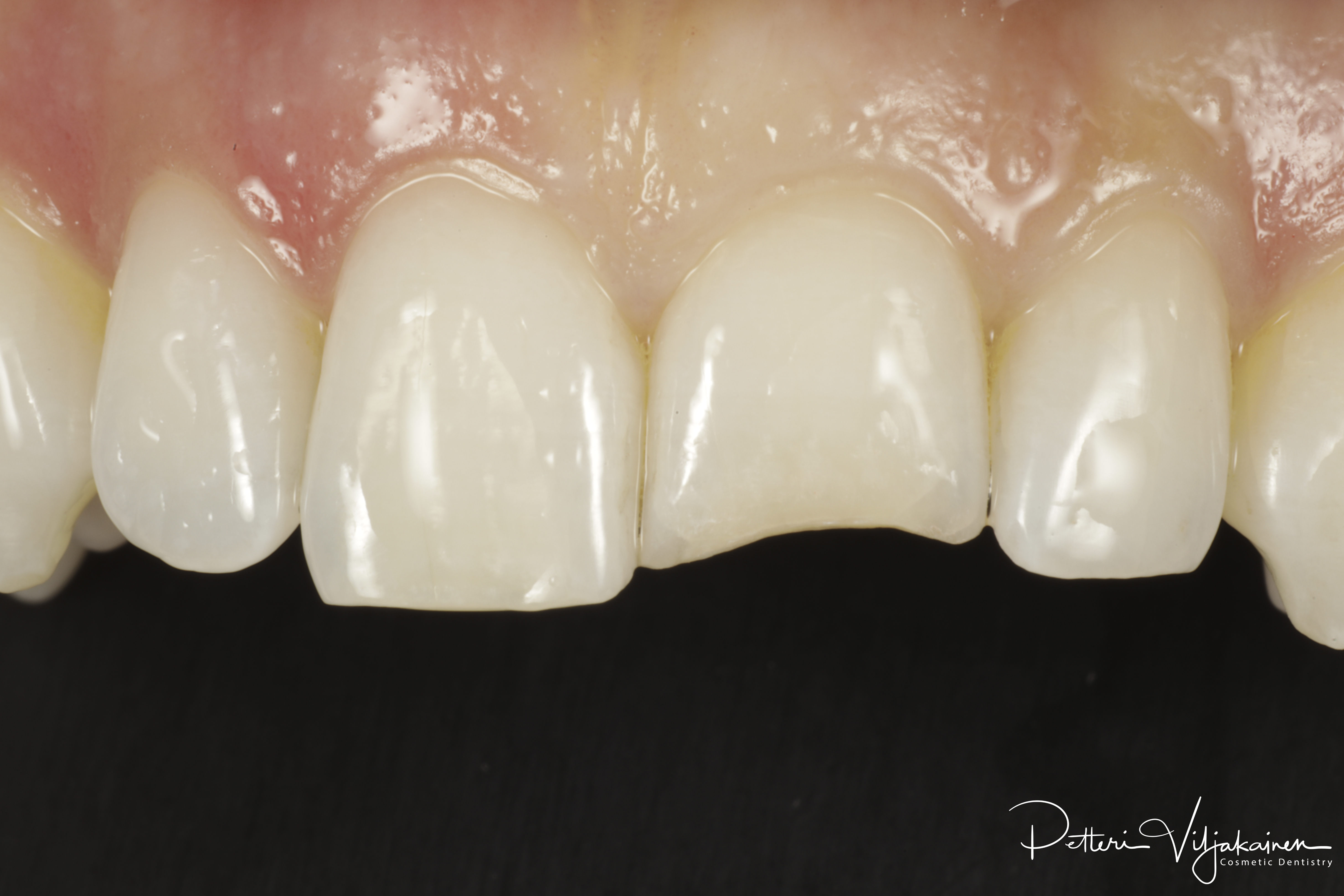 Hampaan hionta esteettistä kerrostusmuovitäytettä varten