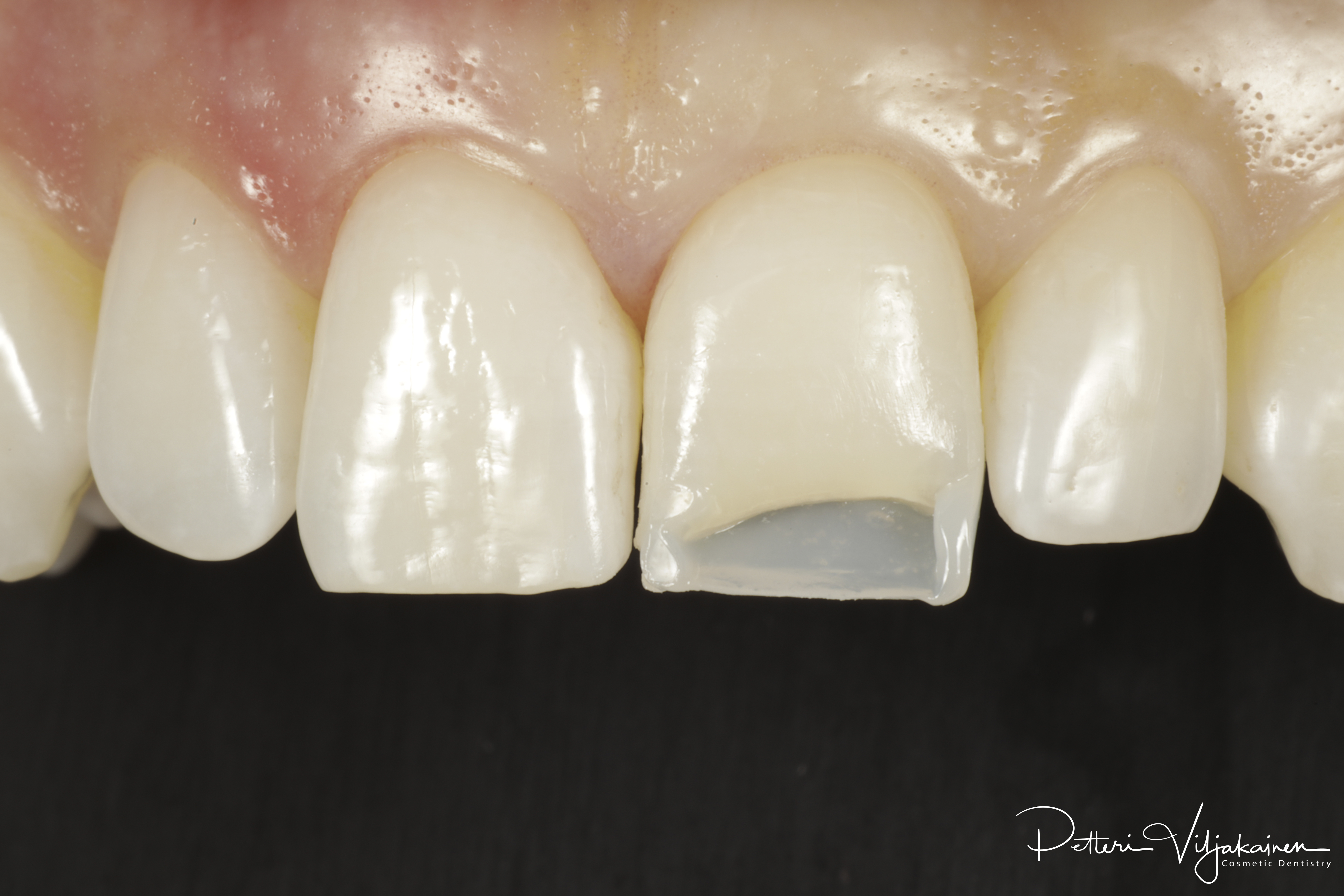 Ensimmäinen kerros paikoillaan esteettistä kerrostusmuovitäytettä varten