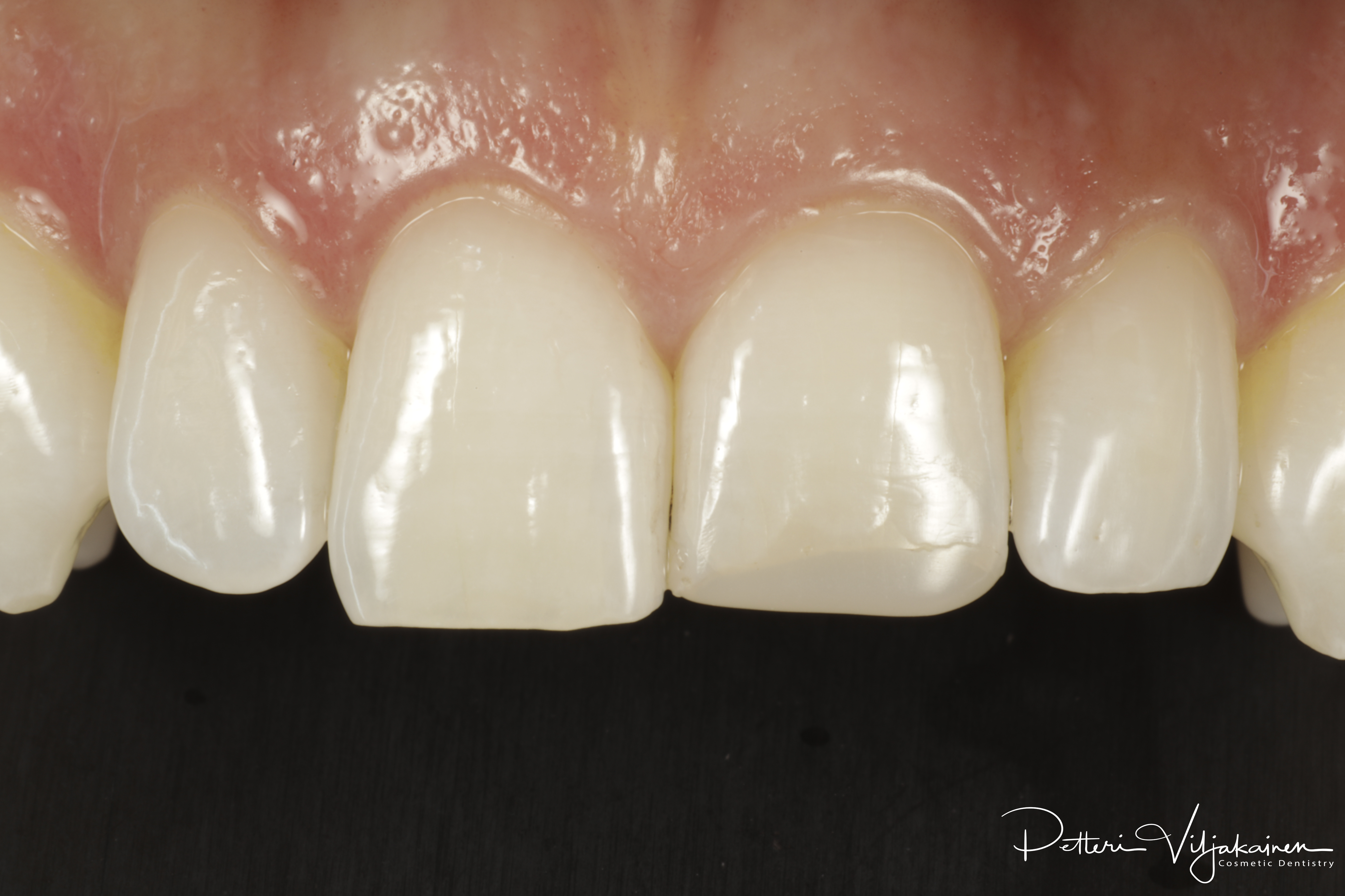 esteettinen kerrostusmuovitäyte alkutilanne