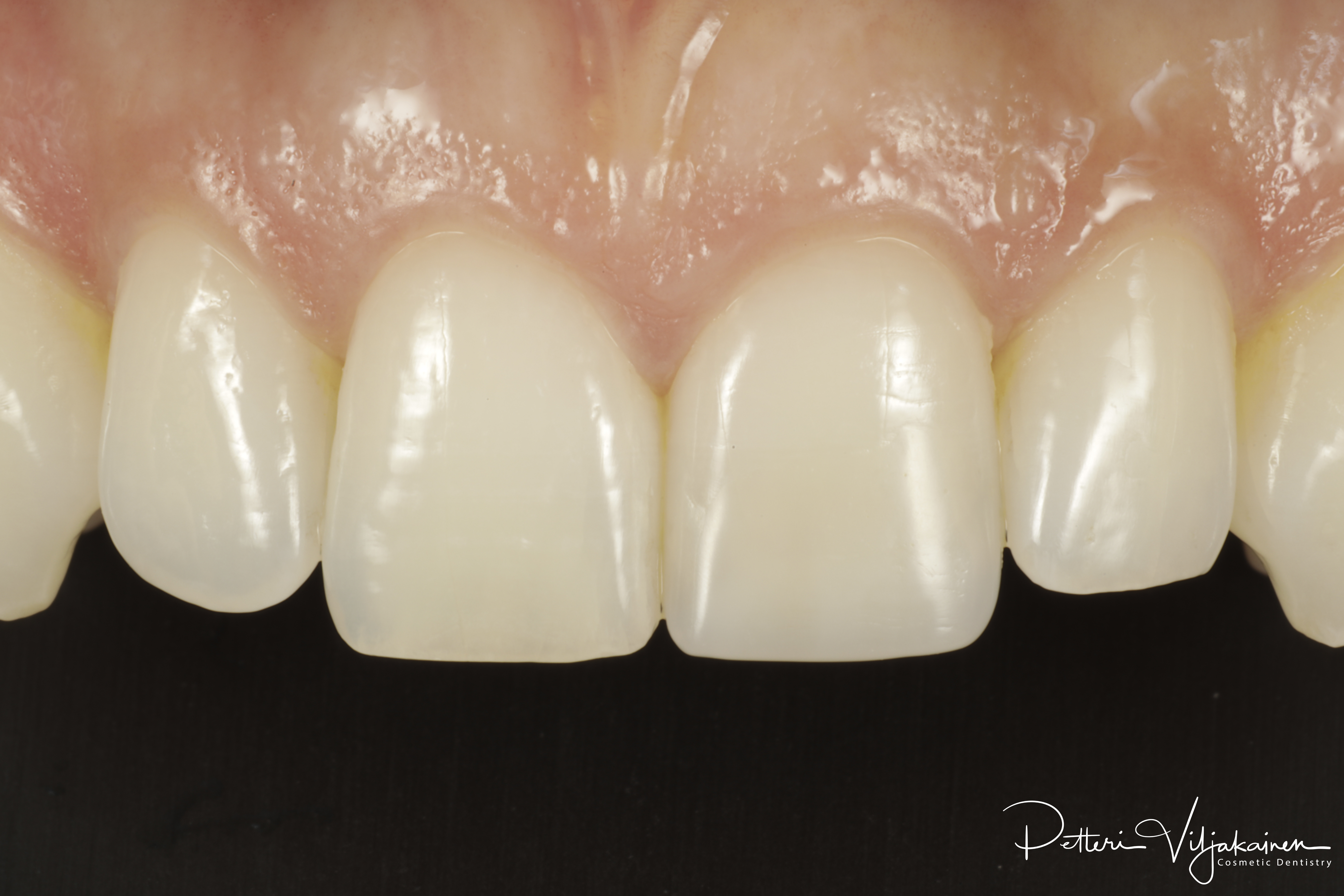 Esteettinen hammashoito lopputilanne. Valmis kerrostustekniikalla valmistettu yhdistelmämuovitäyte paikoillaan.