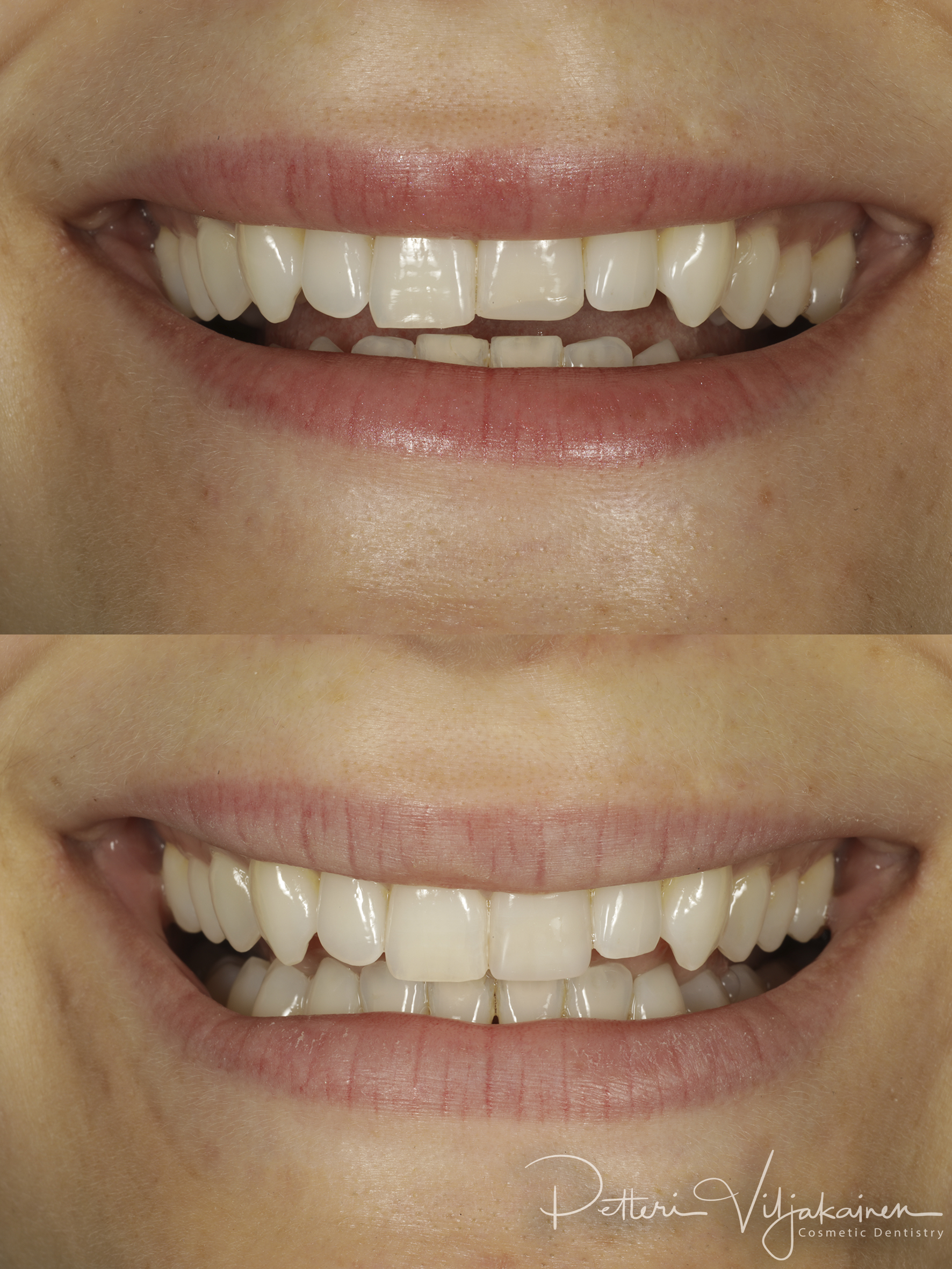 Esteettinen hammashoito lopputilanne. Valmis kerrostustekniikalla valmistettu yhdistelmämuovitäyte paikoillaan.