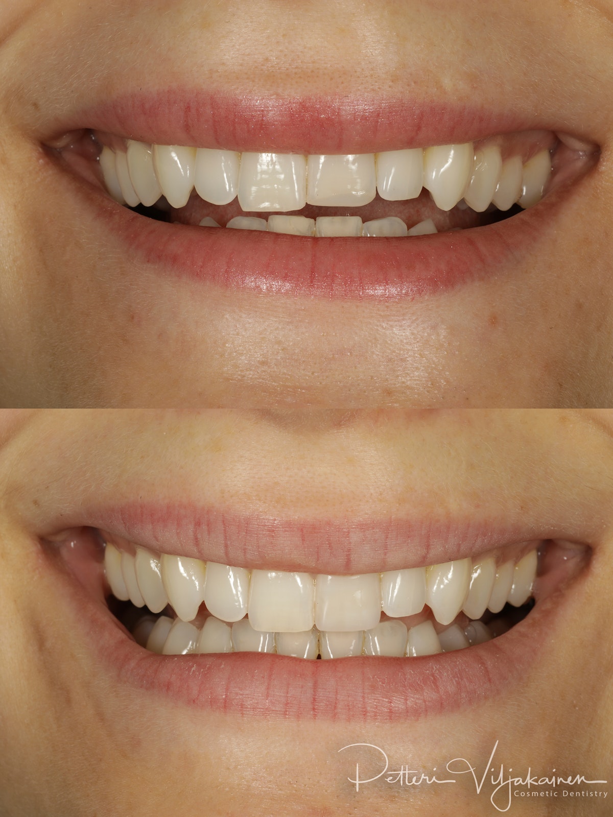 Esteettinen hammashoito lopputilanne. Valmis kerrostustekniikalla valmistettu yhdistelmämuovitäyte paikoillaan.