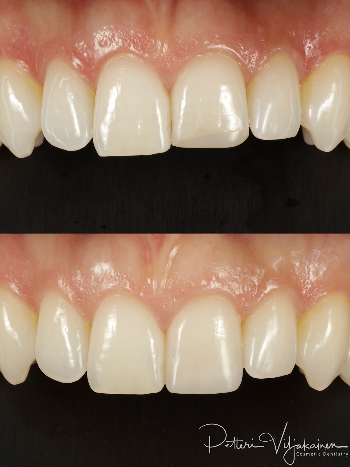 Esteettinen hammashoito lopputilanne. Valmis kerrostustekniikalla valmistettu yhdistelmämuovitäyte paikoillaan.