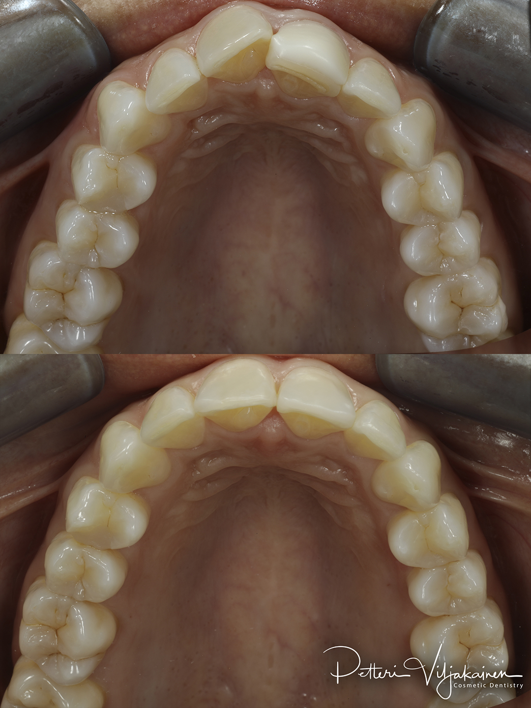 Invisalign oikomishoito ennen/jälkeen.