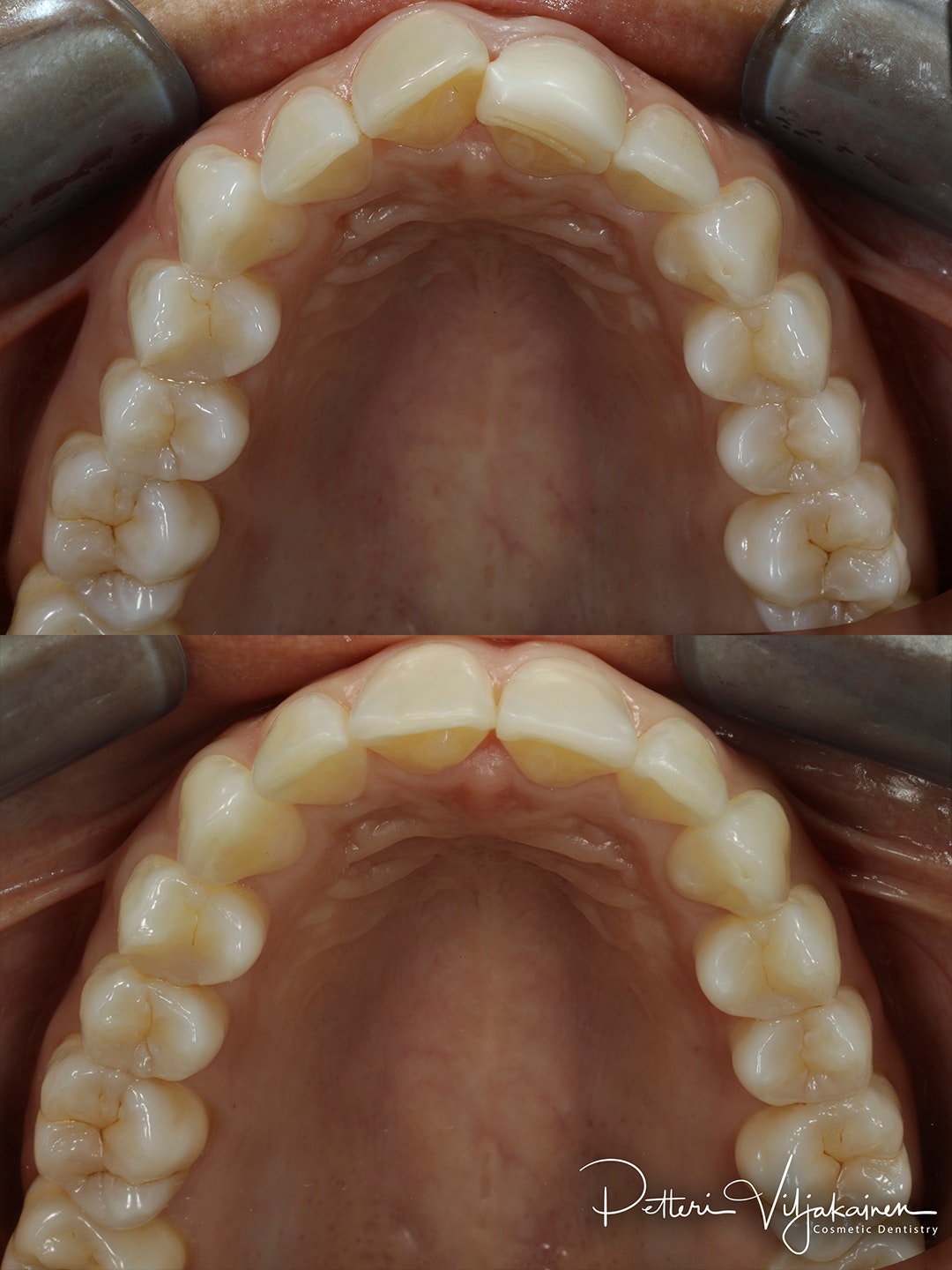 Invisalign oikomishoito ennen/jälkeen.