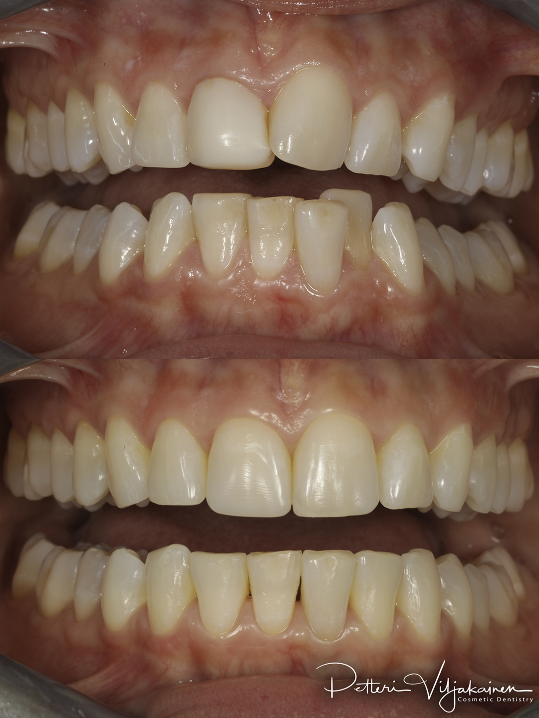Invisalign oikomishoito ennen/jälkeen.