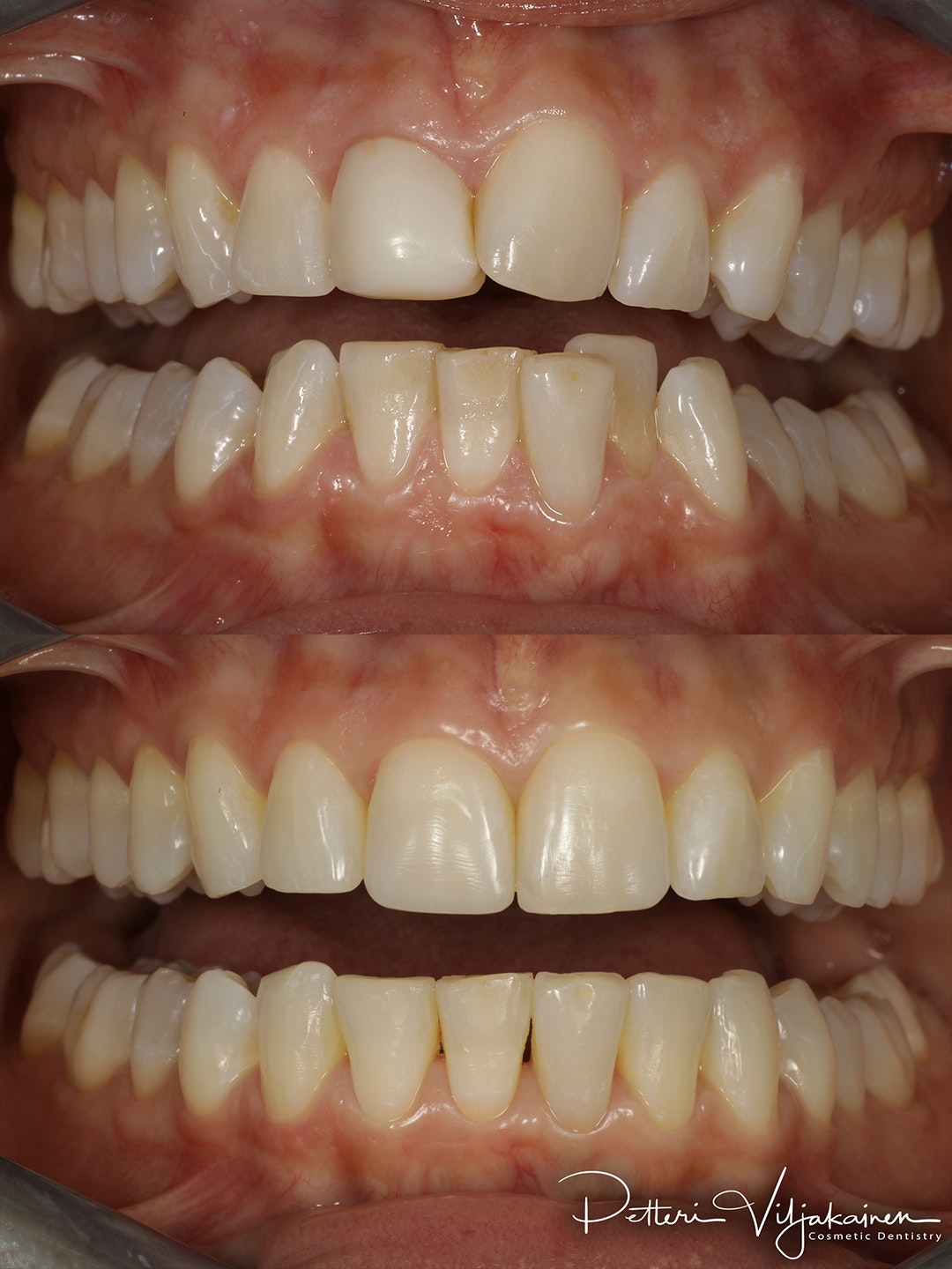 Invisalign oikomishoito ennen/jälkeen.