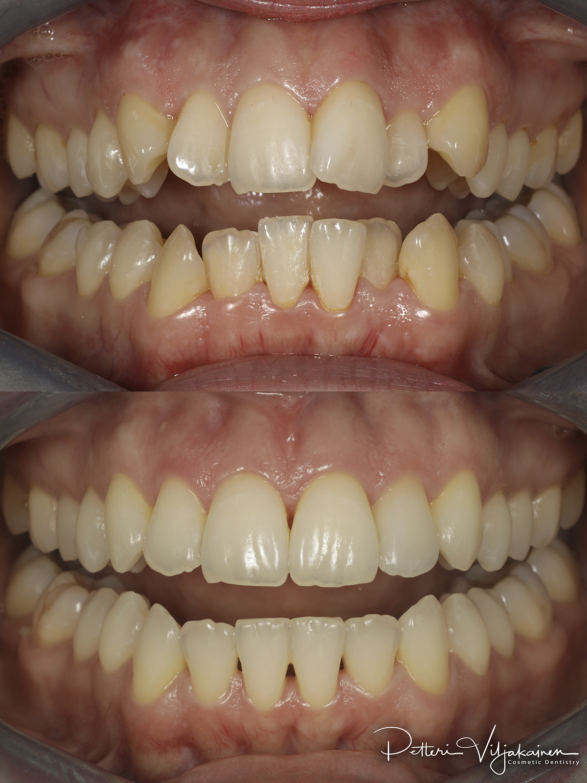 Invisalign oikomishoito. Ennen/jälkeen.