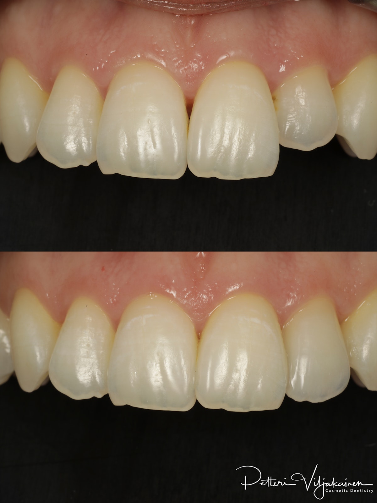 Keraaminen kuori. Hammaslaminaatti. Ennen/jälkeen.