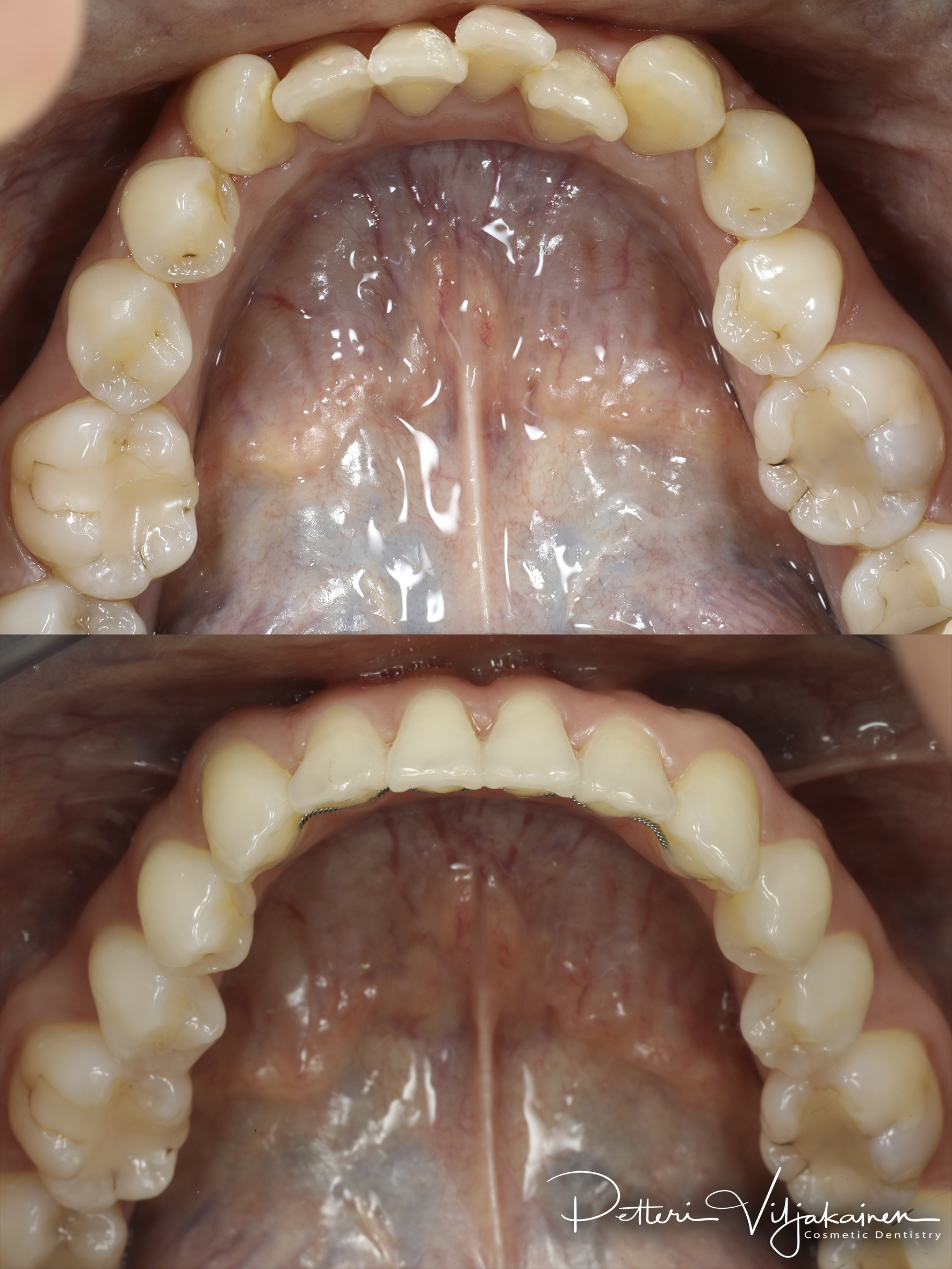 Invisalign oikomishoito. Ennen/jälkeen.