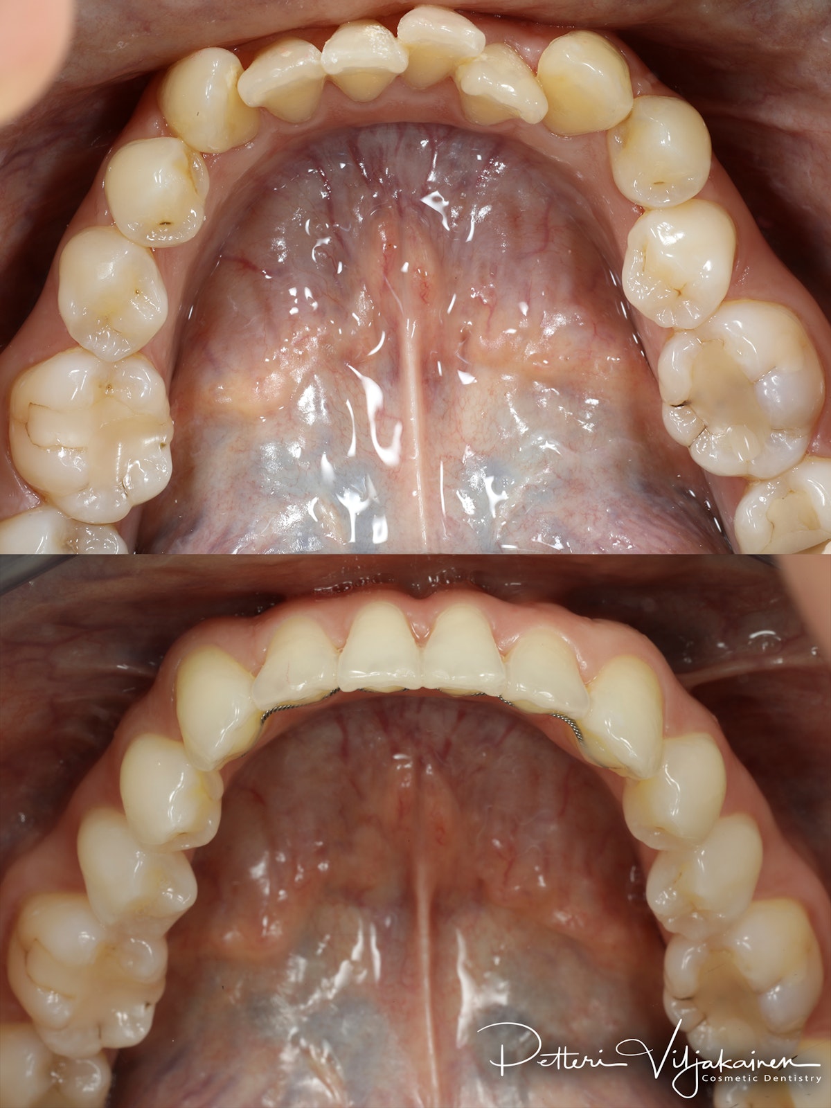 Invisalign oikomishoito. Ennen/jälkeen.