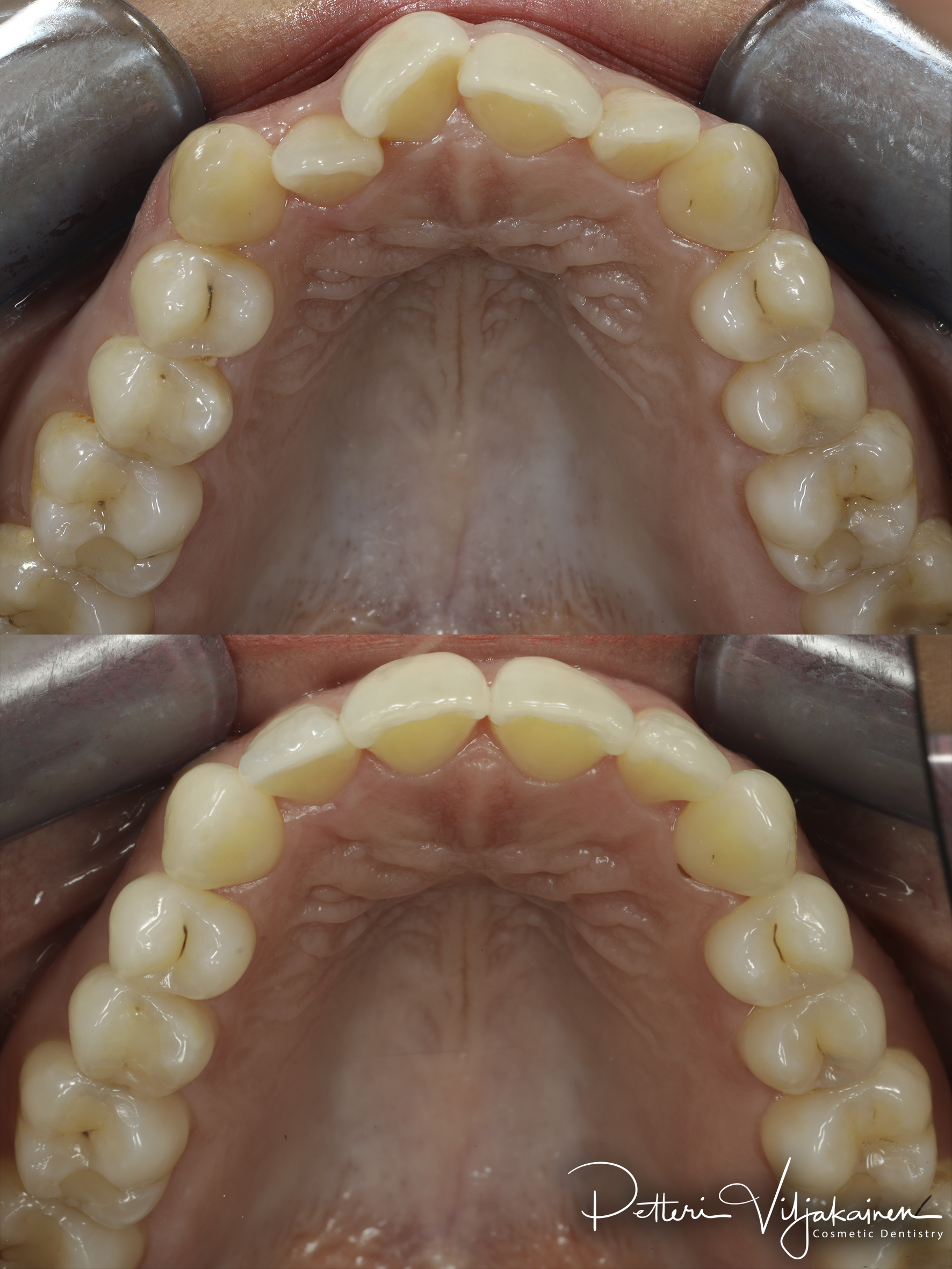 Invisalign oikomishoito. Ennen/jälkeen.