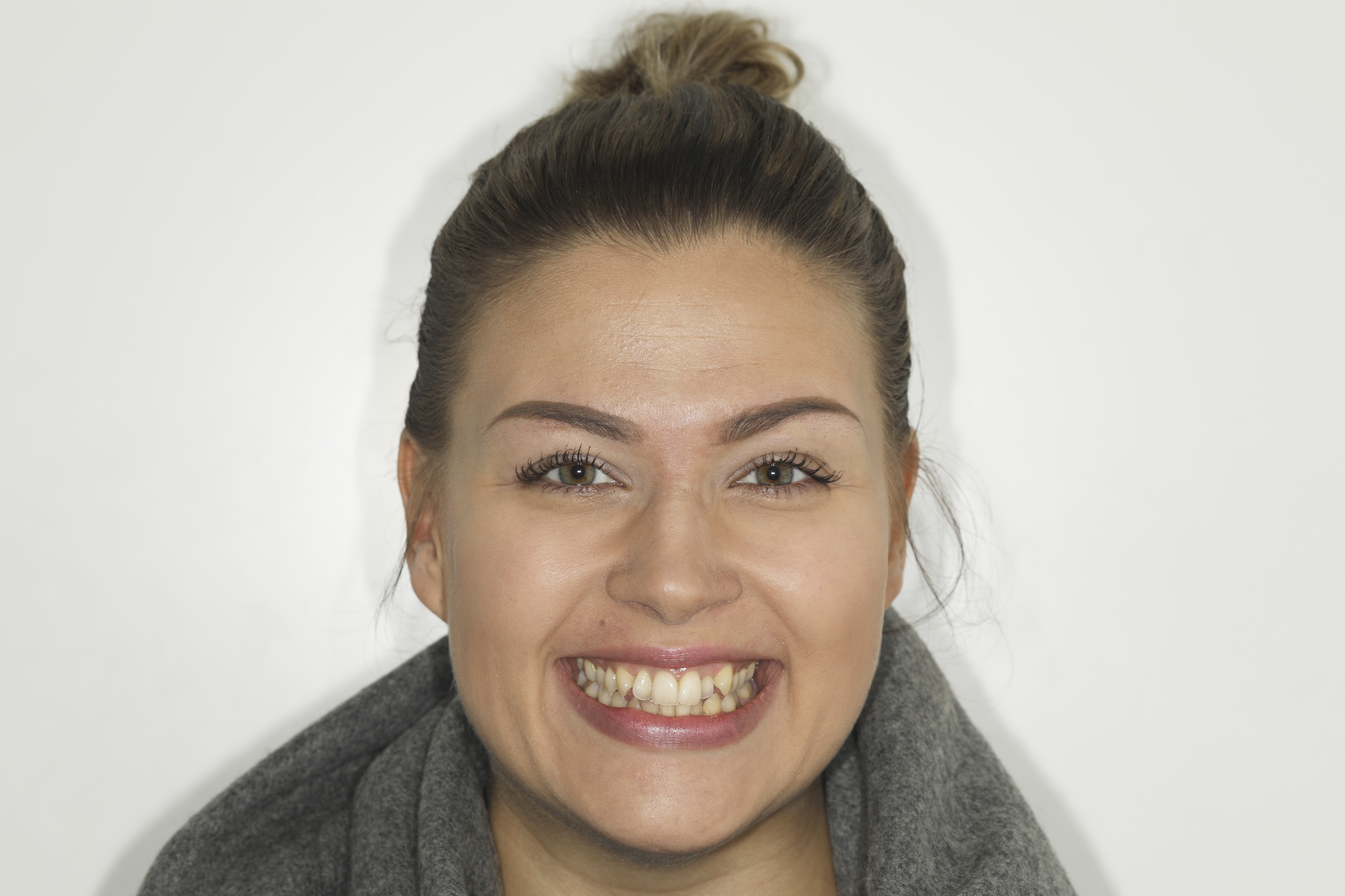 Invisalign oikomishoito.