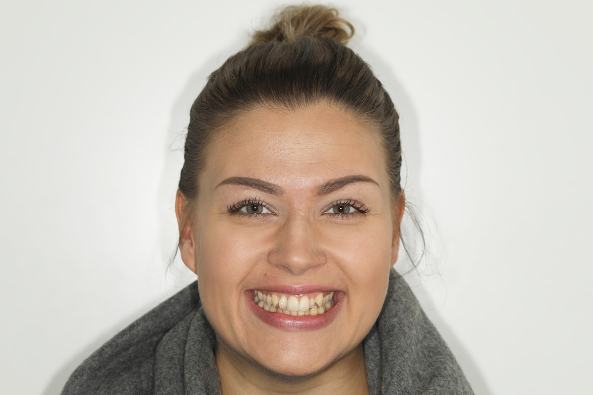 Invisalign oikomishoito.