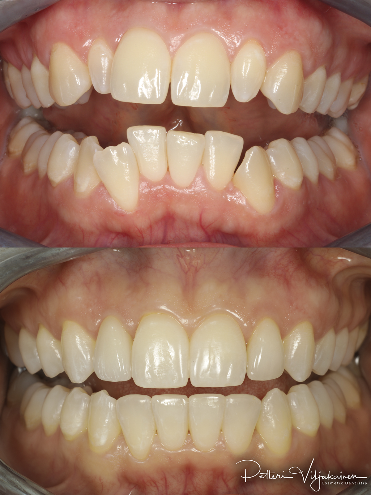 invisalign oikomishoito hampaat ennen jälkeen keraamiset kuoret