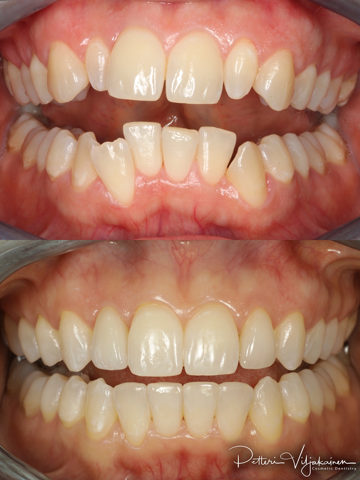 invisalign oikomishoito hampaat ennen jälkeen keraamiset kuoret