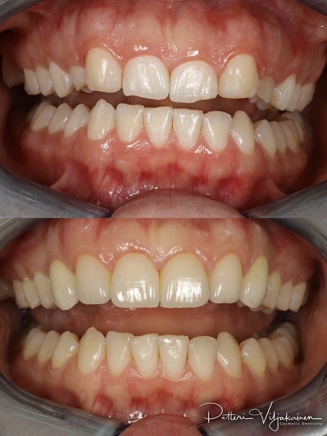 Esteettinen hammashoito ennen jälkeen. Yksittäinen keraaminen kuori eli hammaslaminaatti etuhampaassa.