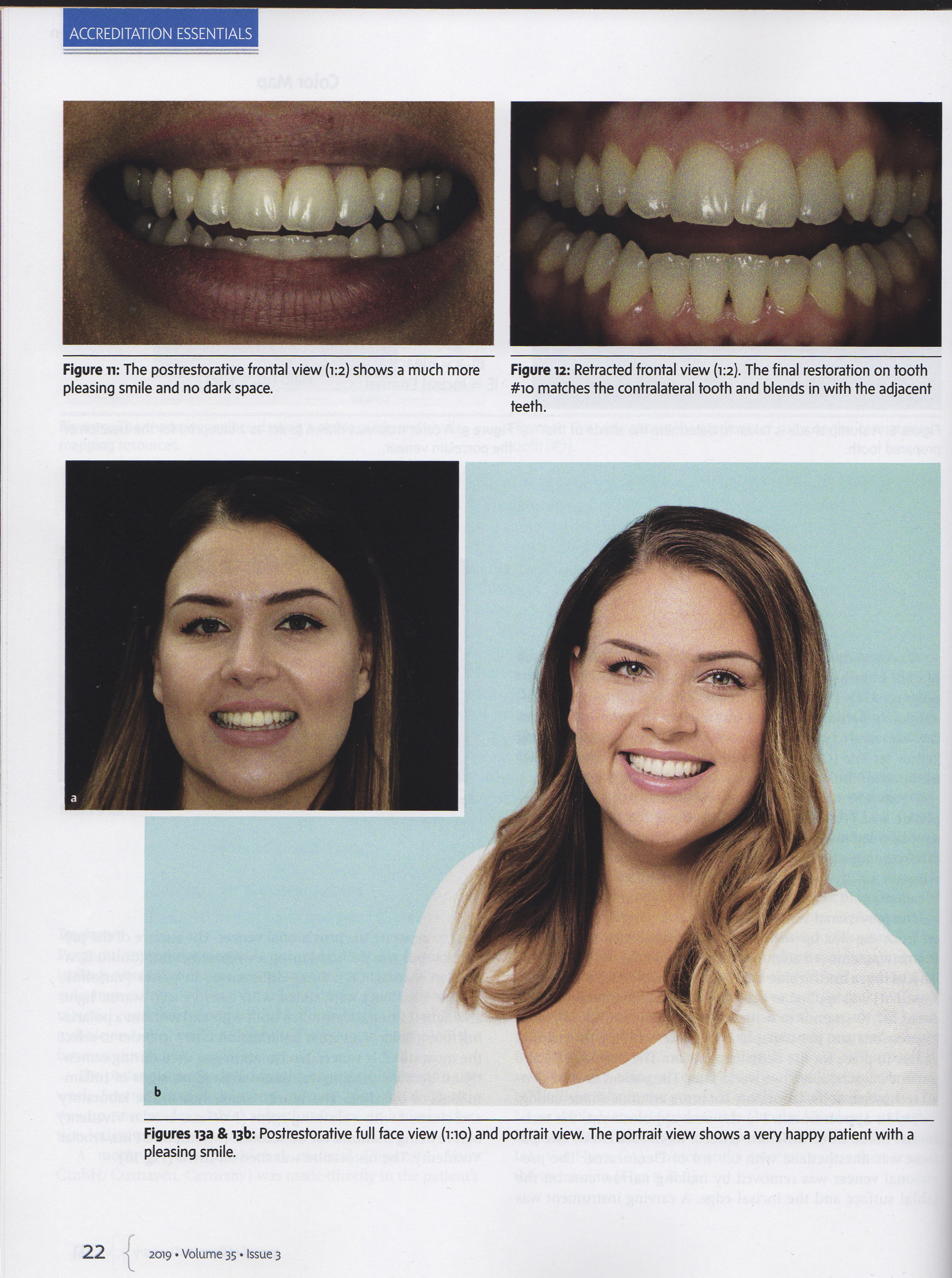 Esteettinen hammashoito Helsinki hampaat ennen