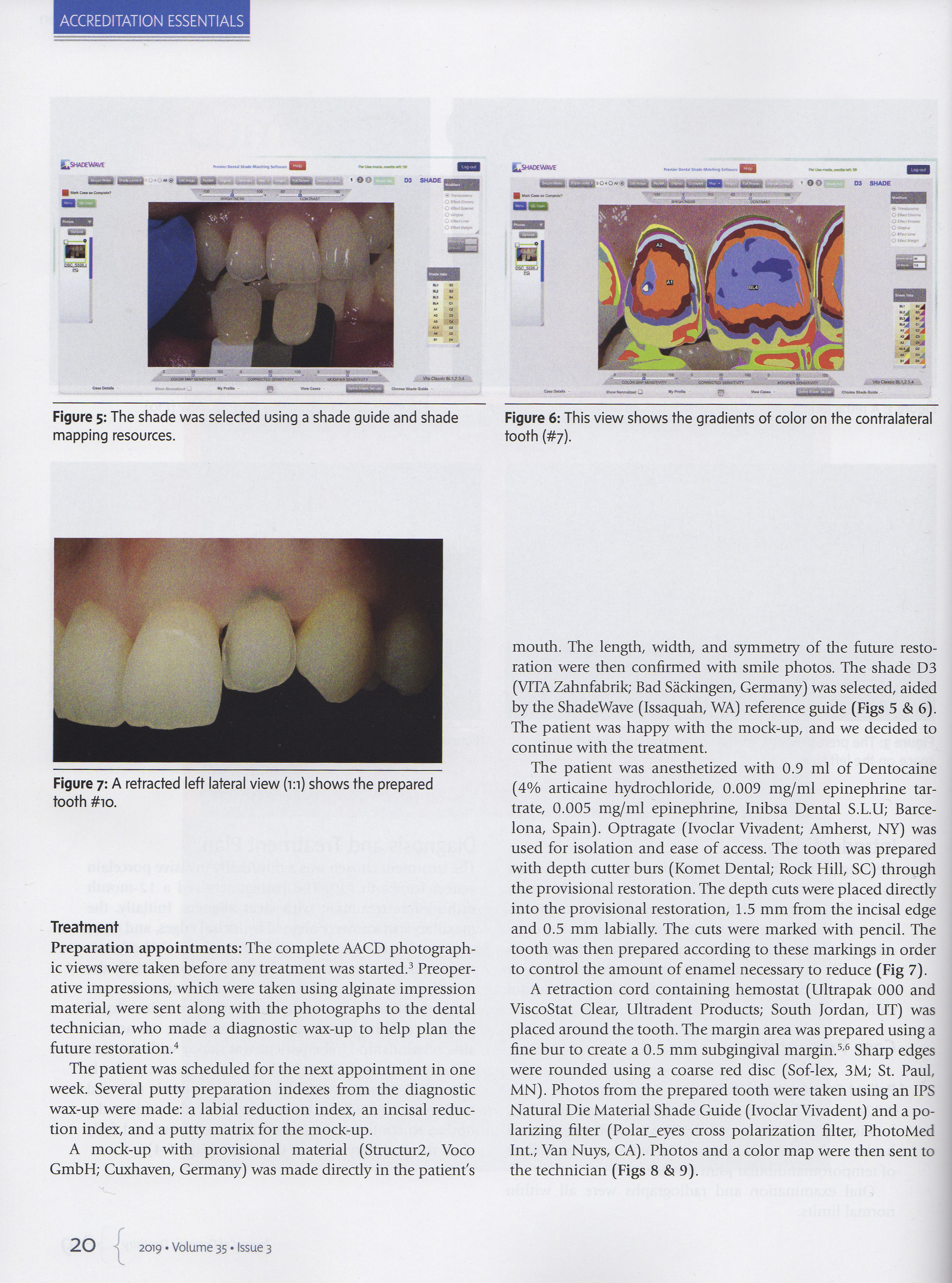 Esteettinen hammashoito Helsinki hampaat ennen