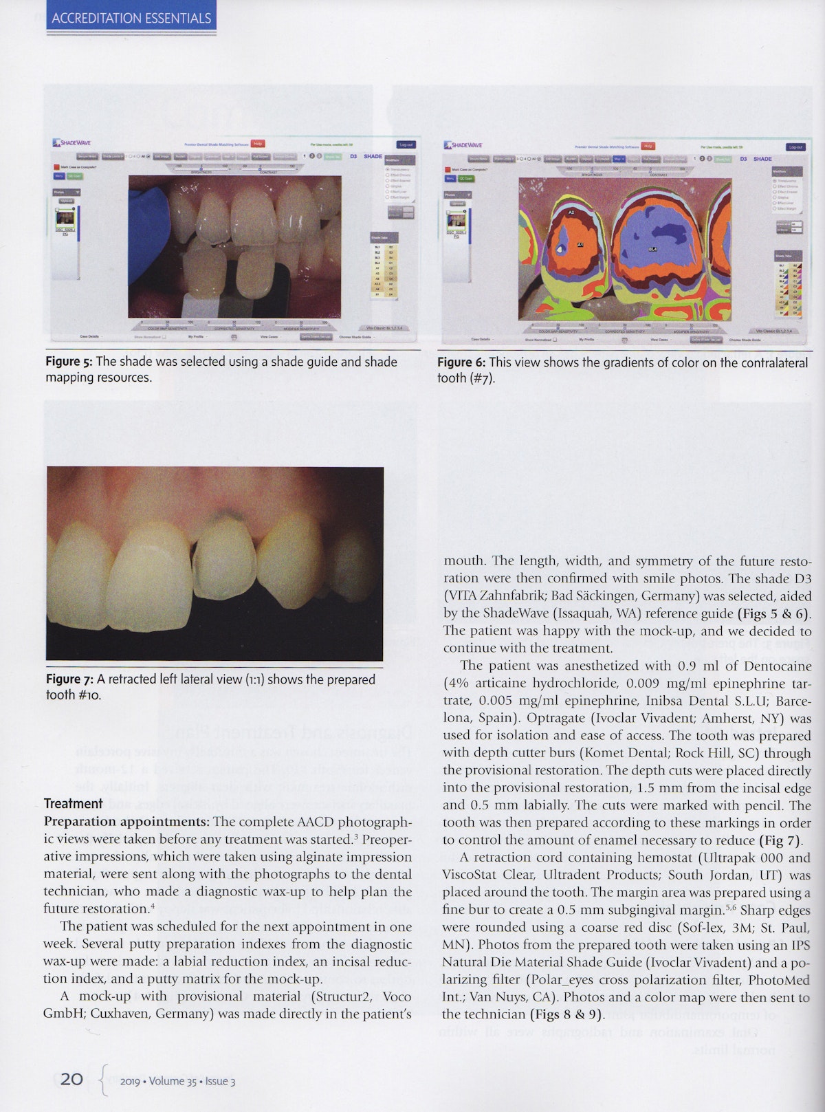 Journal of Cosmetic Dentisry article. dr. Petteri Viljakainen. Keraaminen kuori. Ceramic veneer. Invisalign.