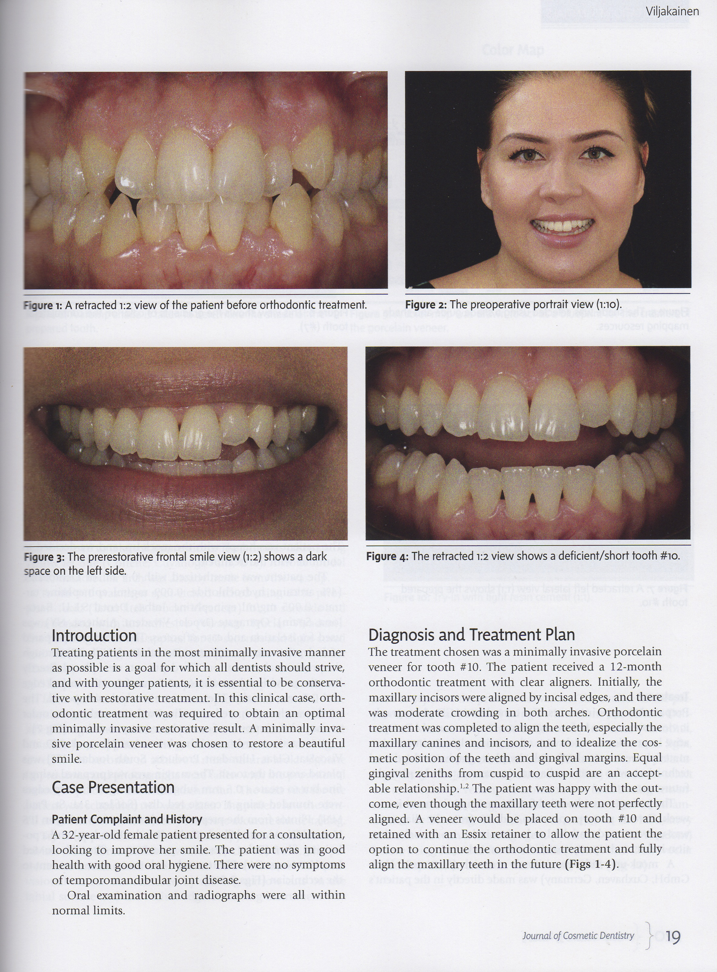 Esteettinen hammashoito Helsinki hampaat ennen