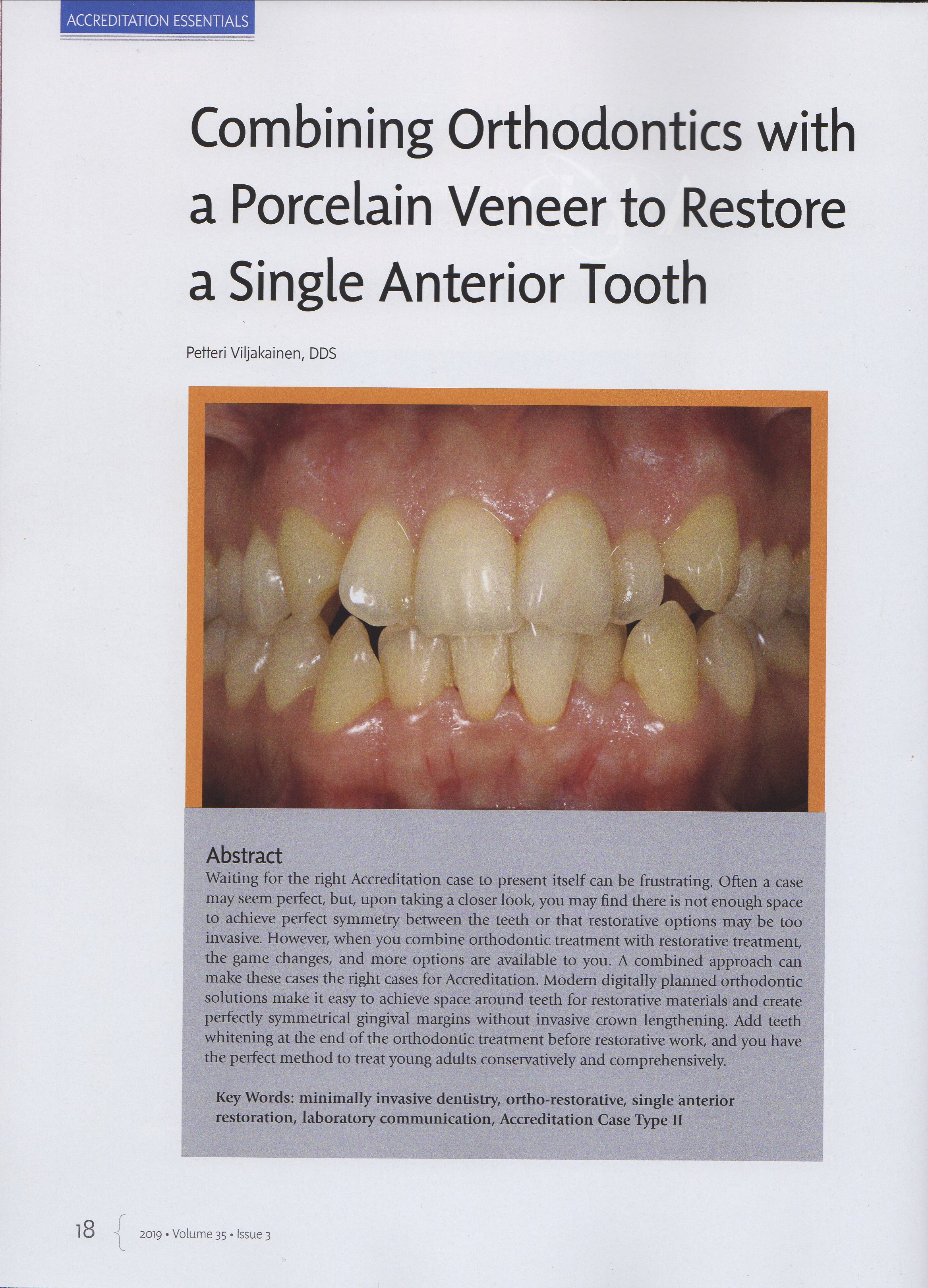Esteettinen hammashoito Helsinki hampaat ennen