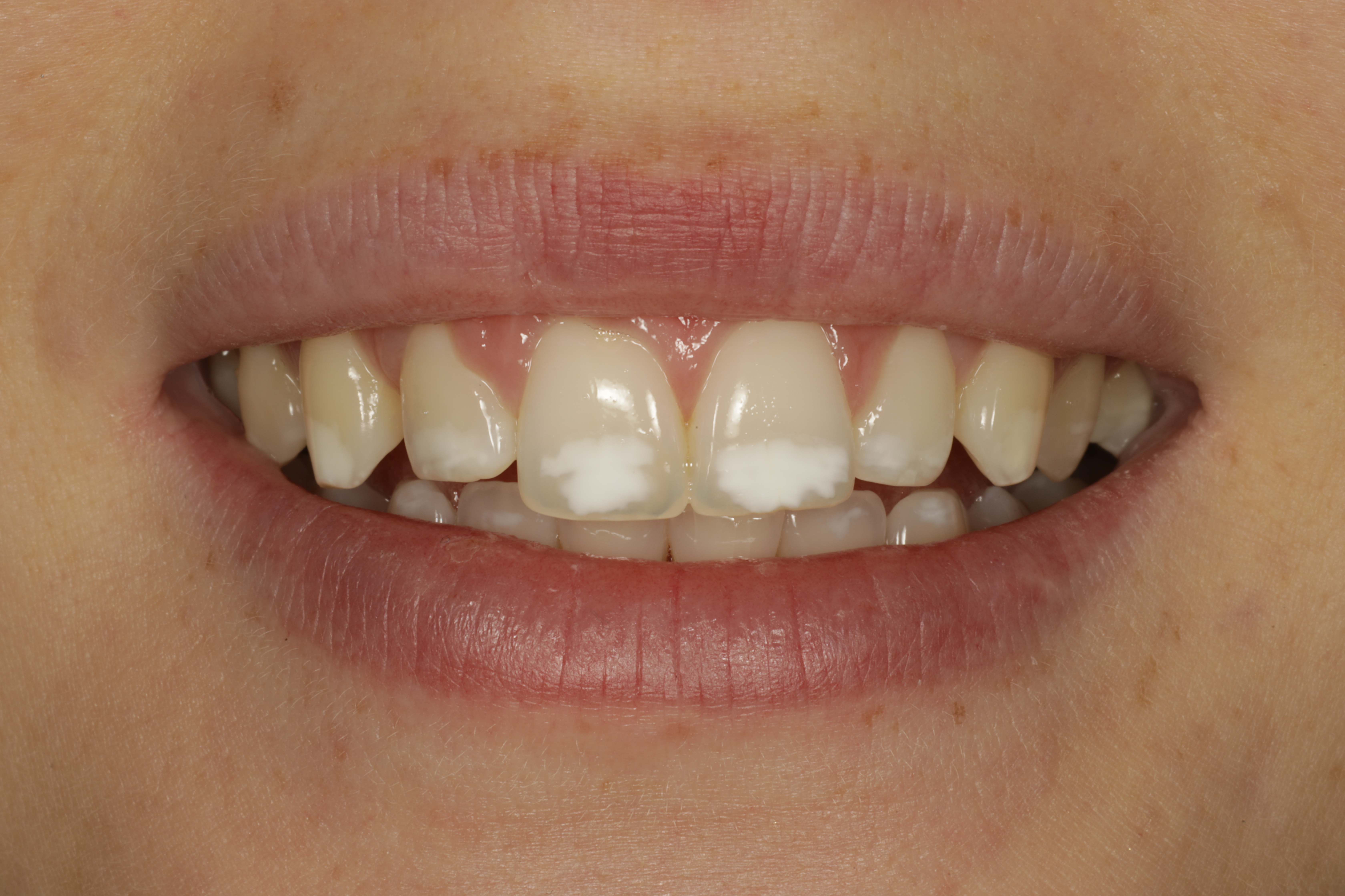 Hypoplasioiden eli vaaleiden täplien hoito resiini-infiltraatiotekniikalla