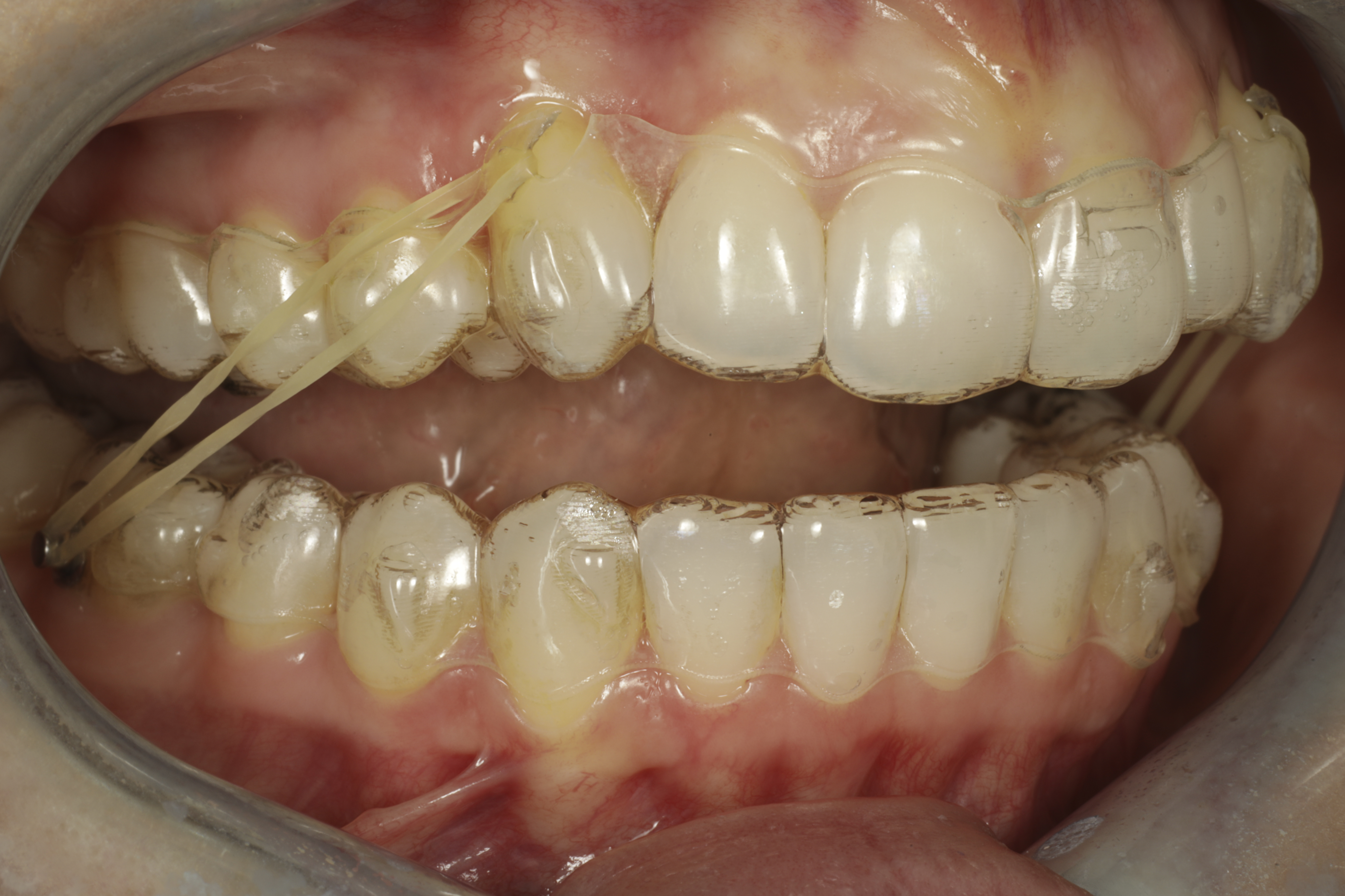 invisalign oikomishoito kuminauhat Class II elastics