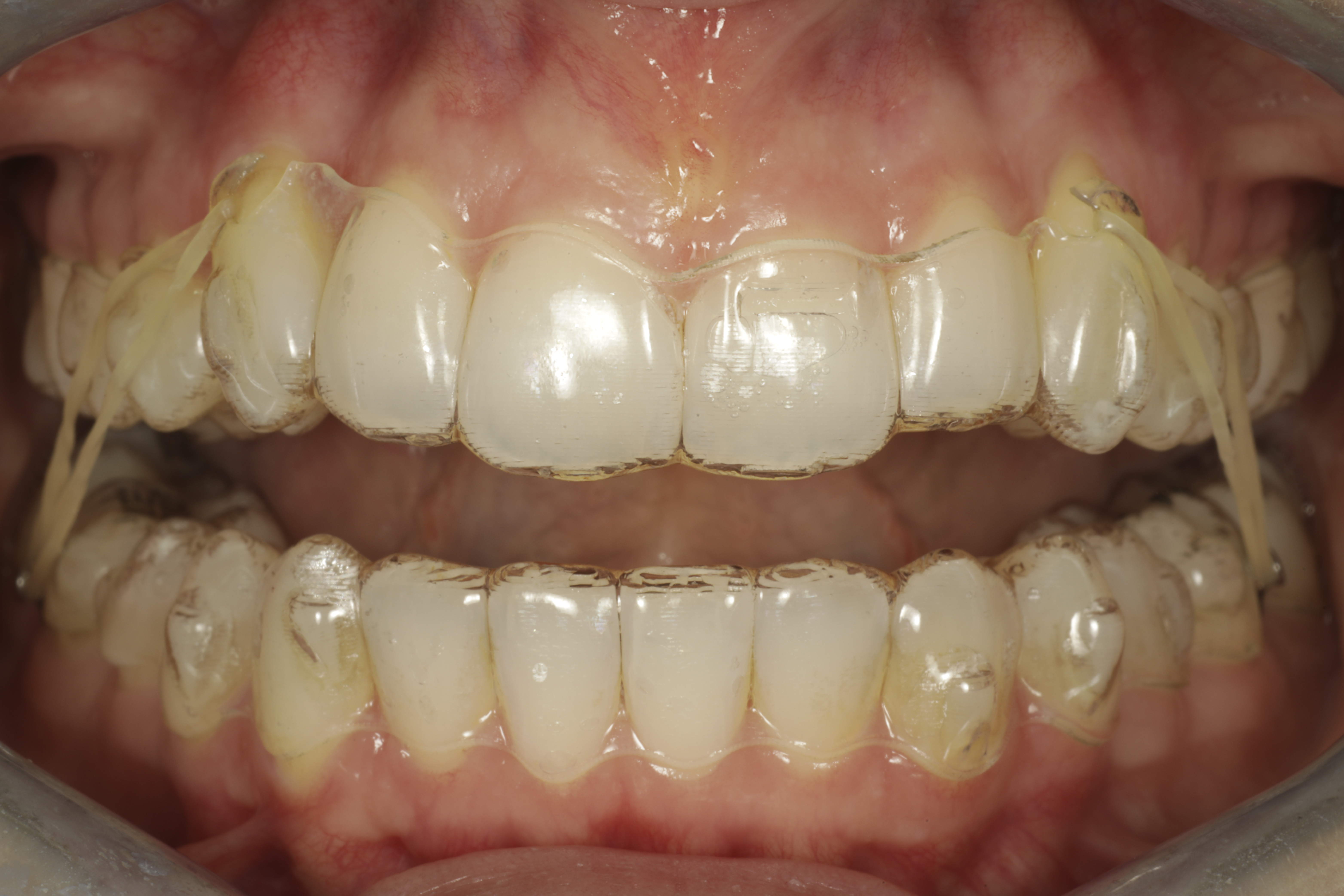 invisalign oikomishoito kuminauhat Class II elastics