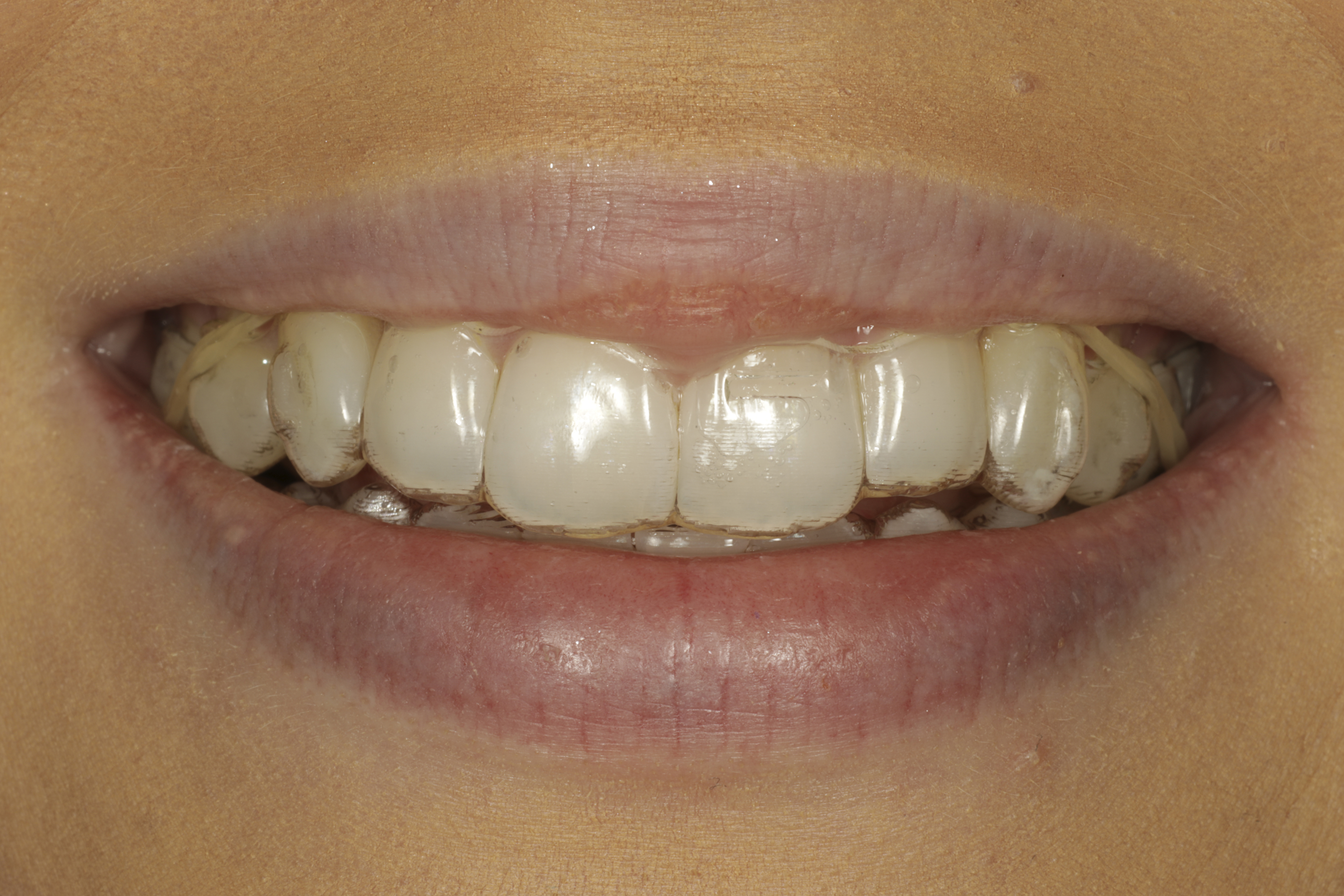 invisalign oikomishoito kuminauhat Class II elastics