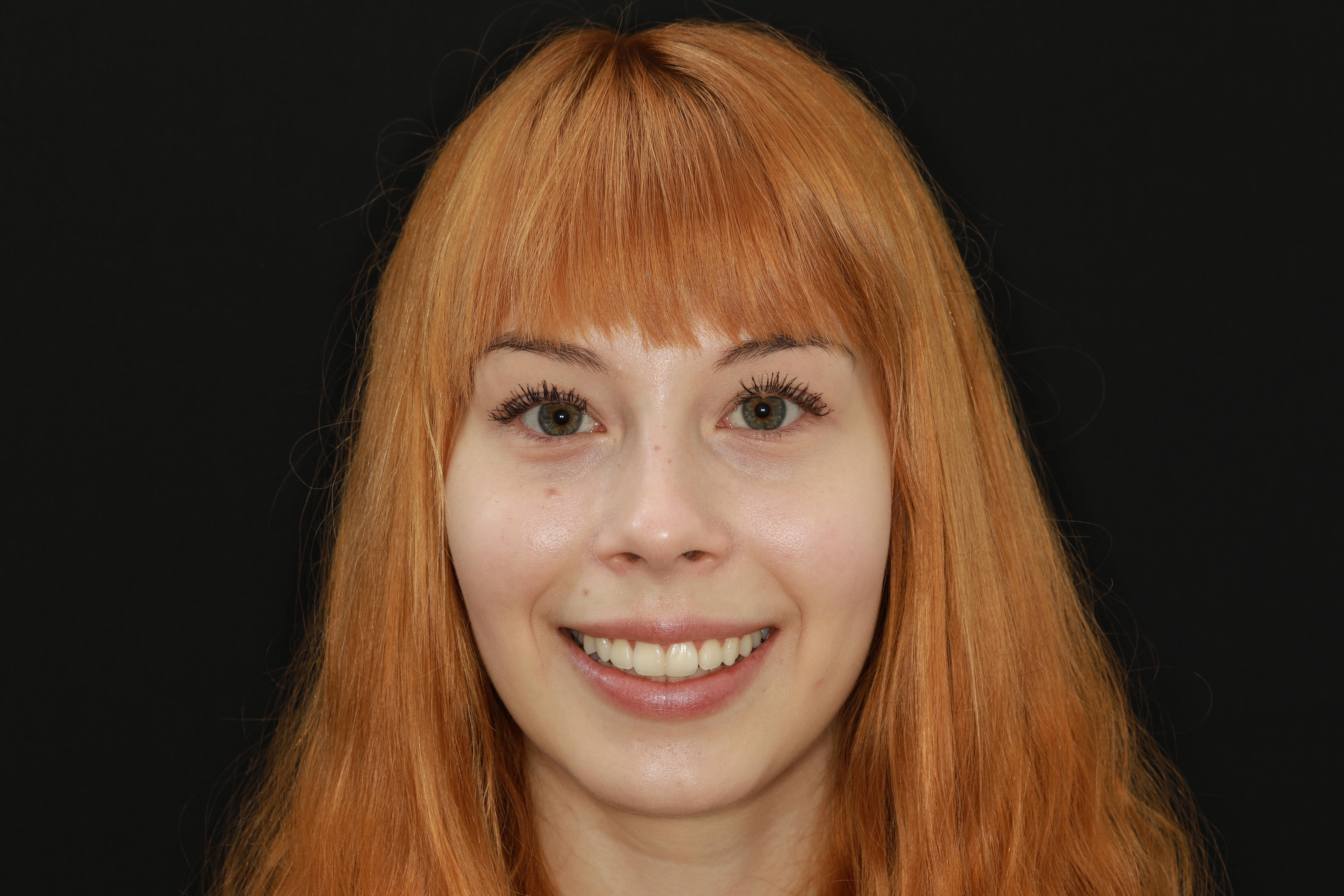 Ella invisalign valmis. Esteettiset kerrostusmuovit keskimmäisissä etuhampaissa.