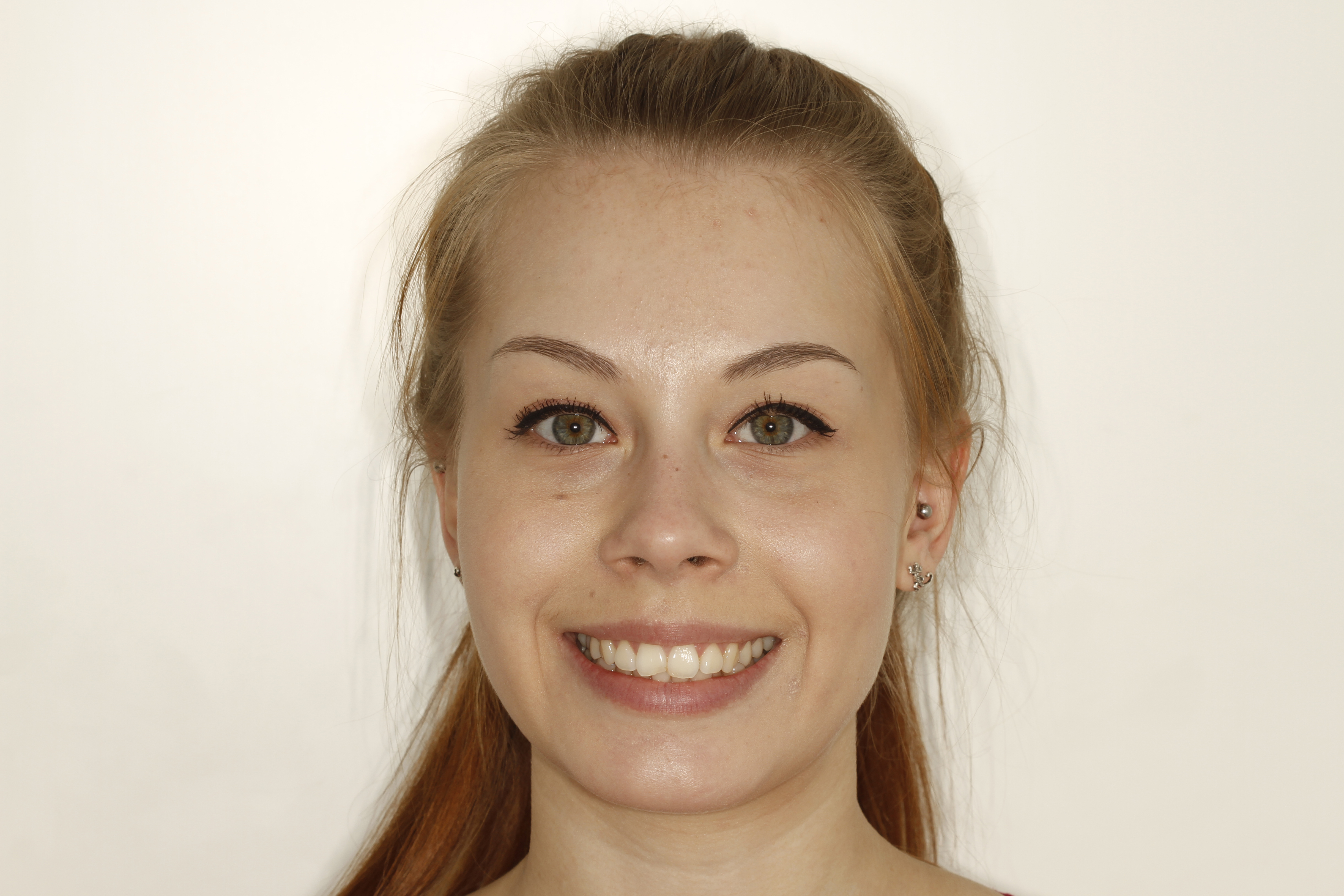 Invisalign oikomishoito ennen. Esteettiset kerrostusmuovit keskimmäisissä etuhampaissa.