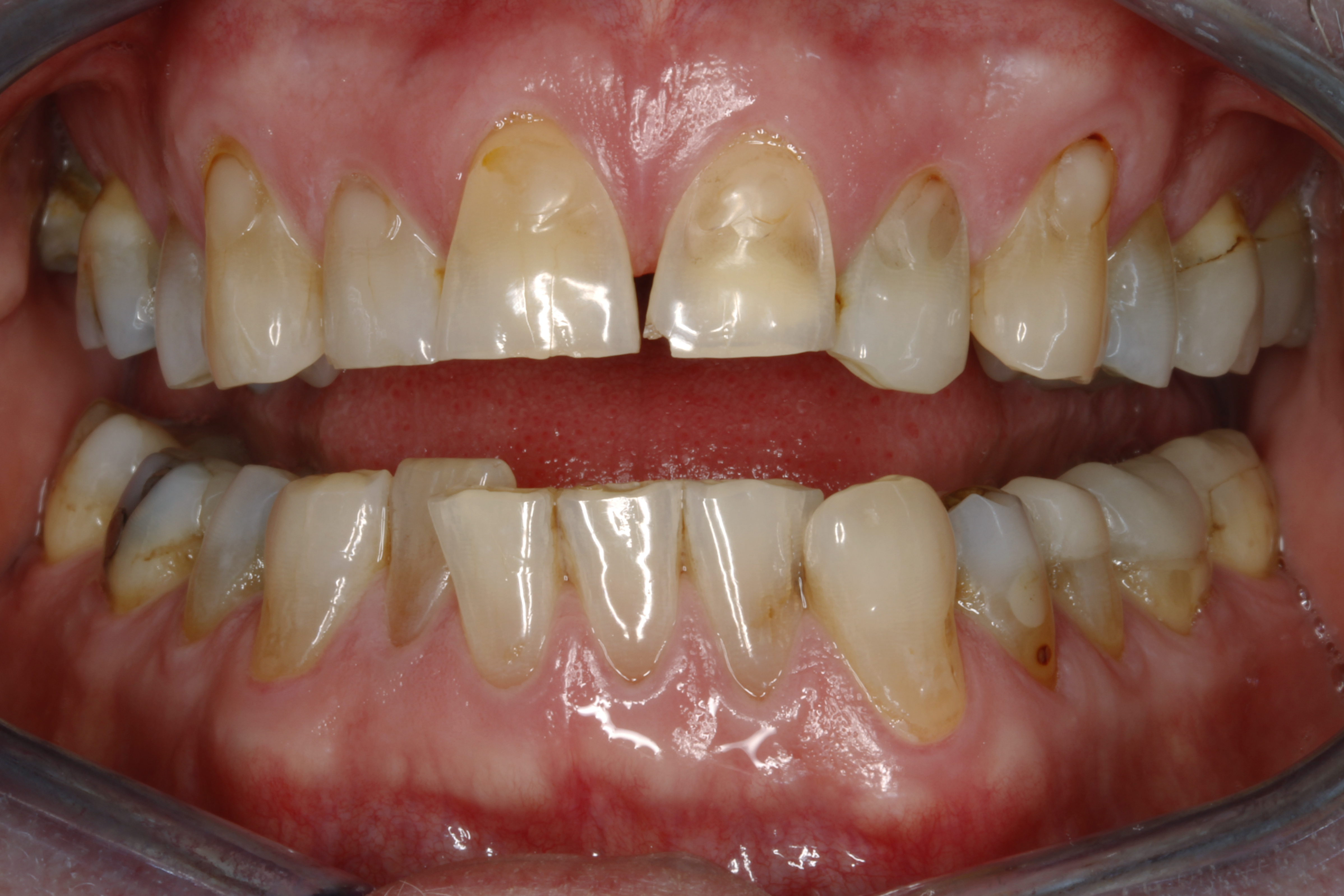 Invisalign oikomishoito ennen.