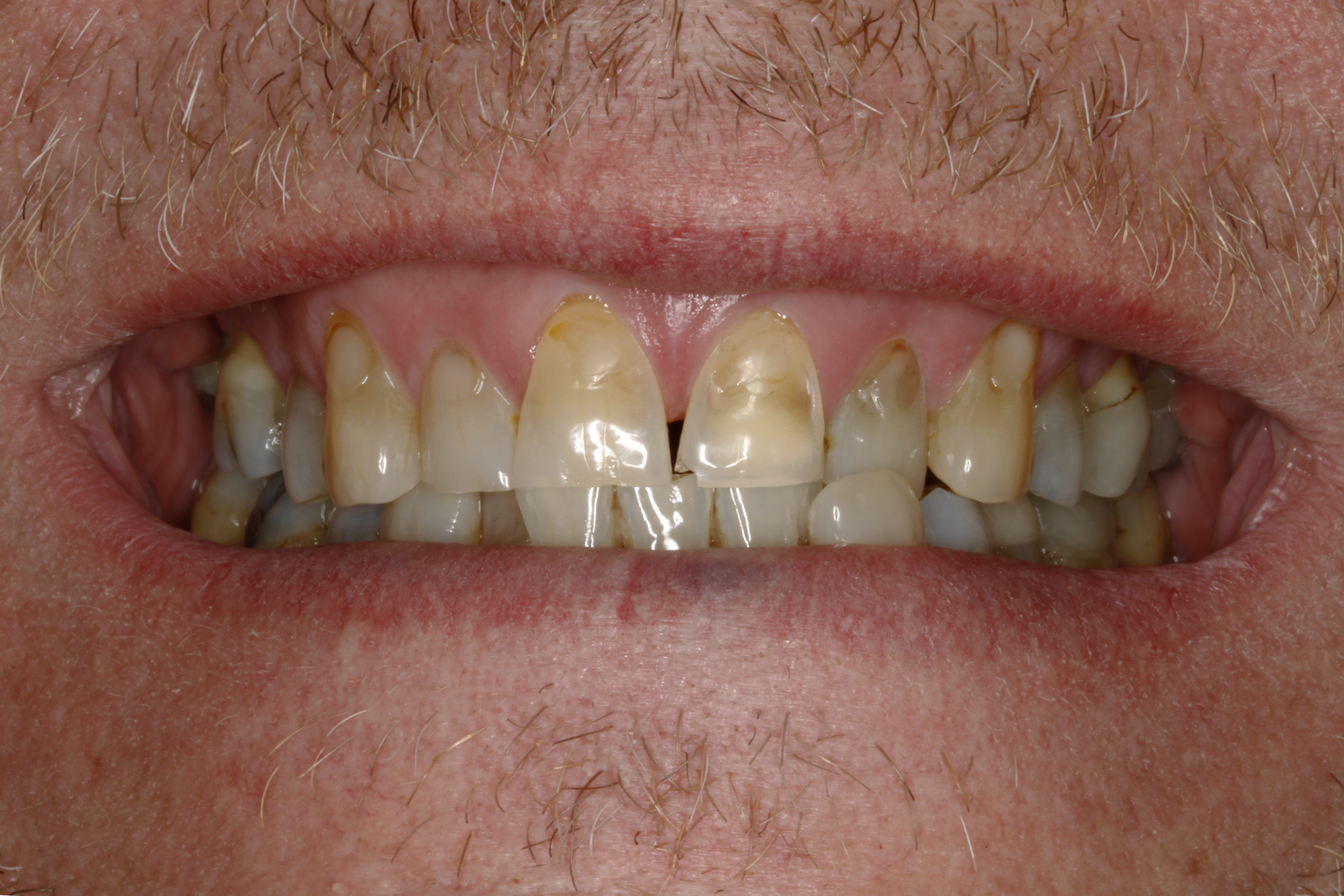 Invisalign oikomishoito ennen.