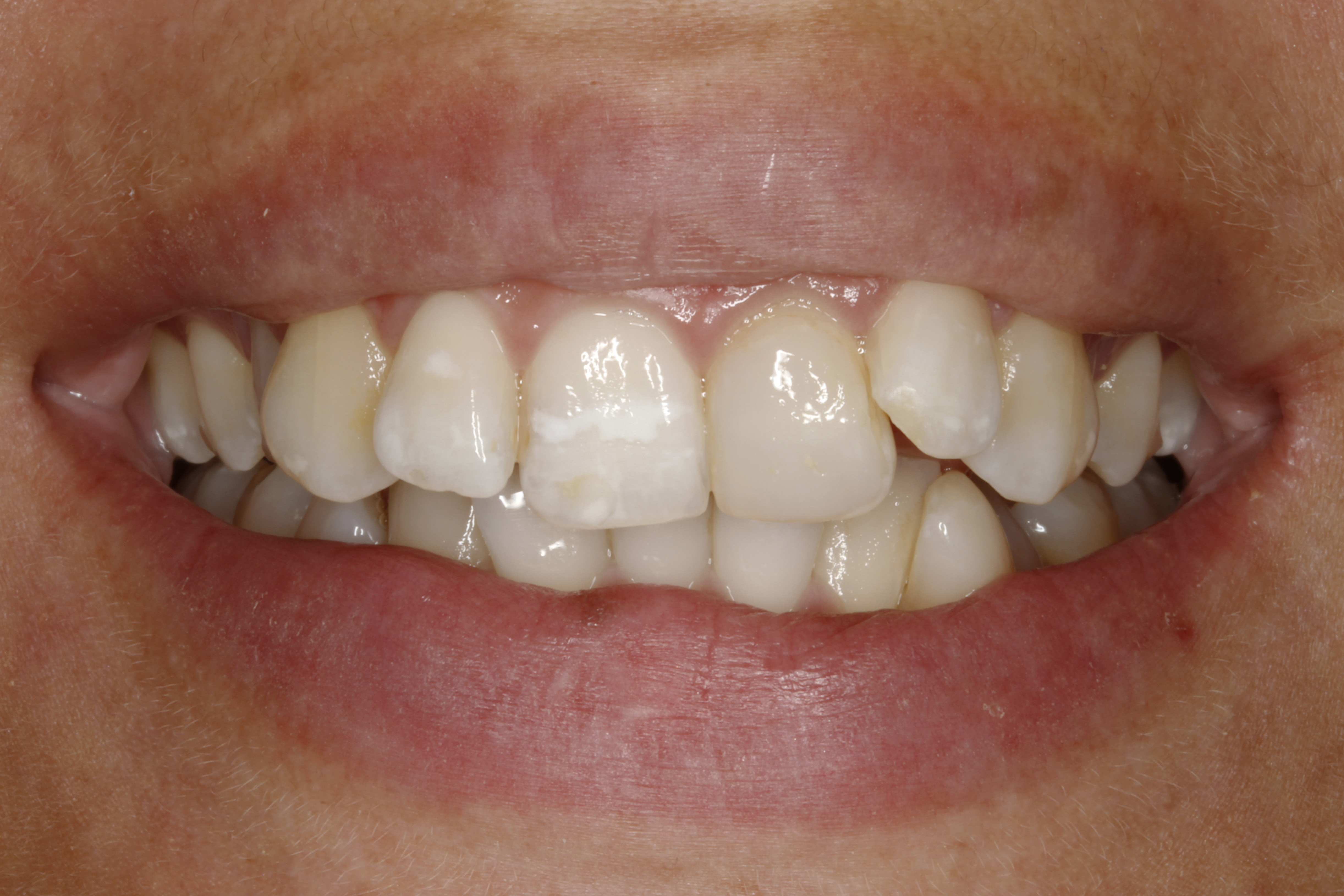 Invisalign oikomishoito tilanne ennen oikomista