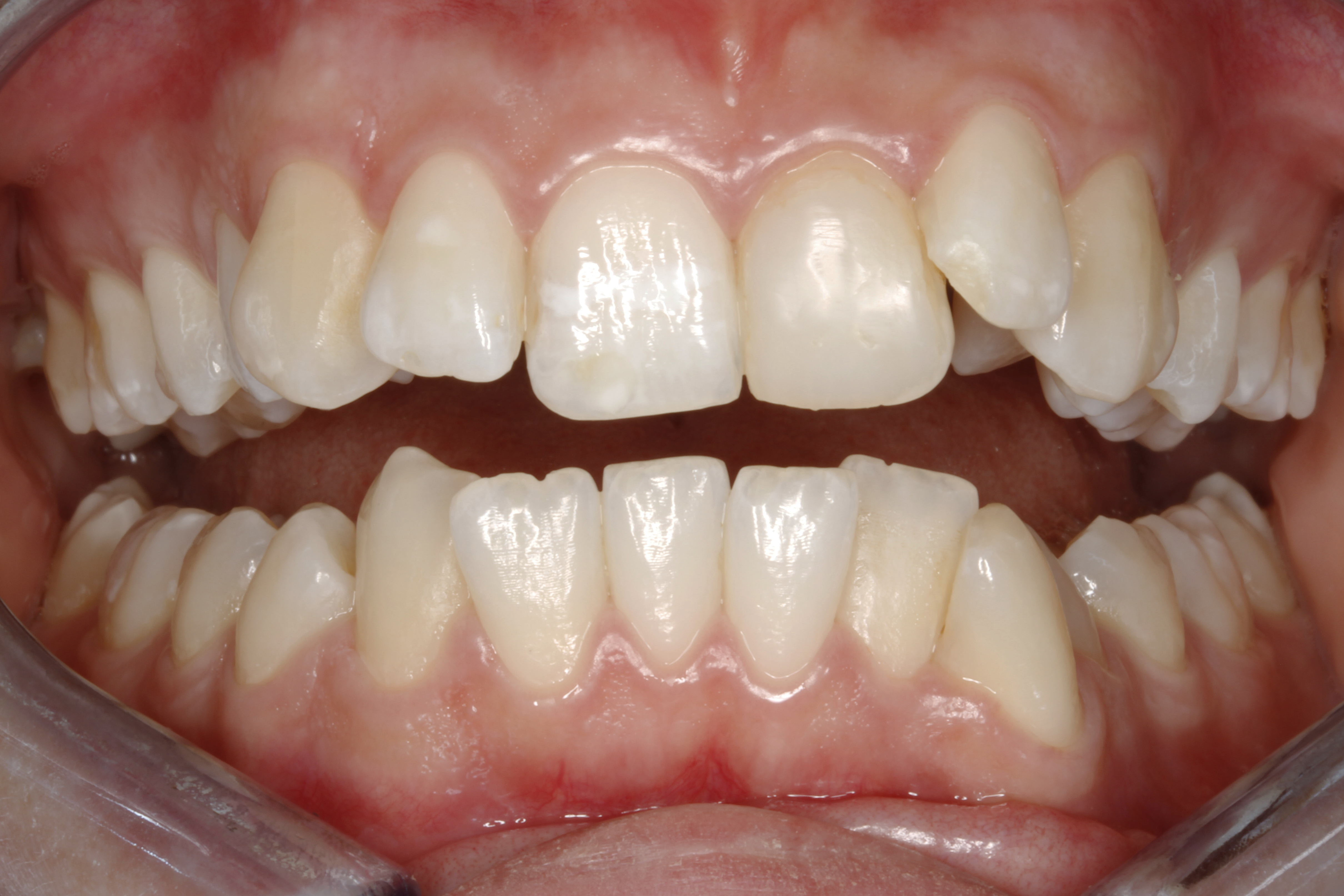 Invisalign oikomishoito tilanne ennen oikomista