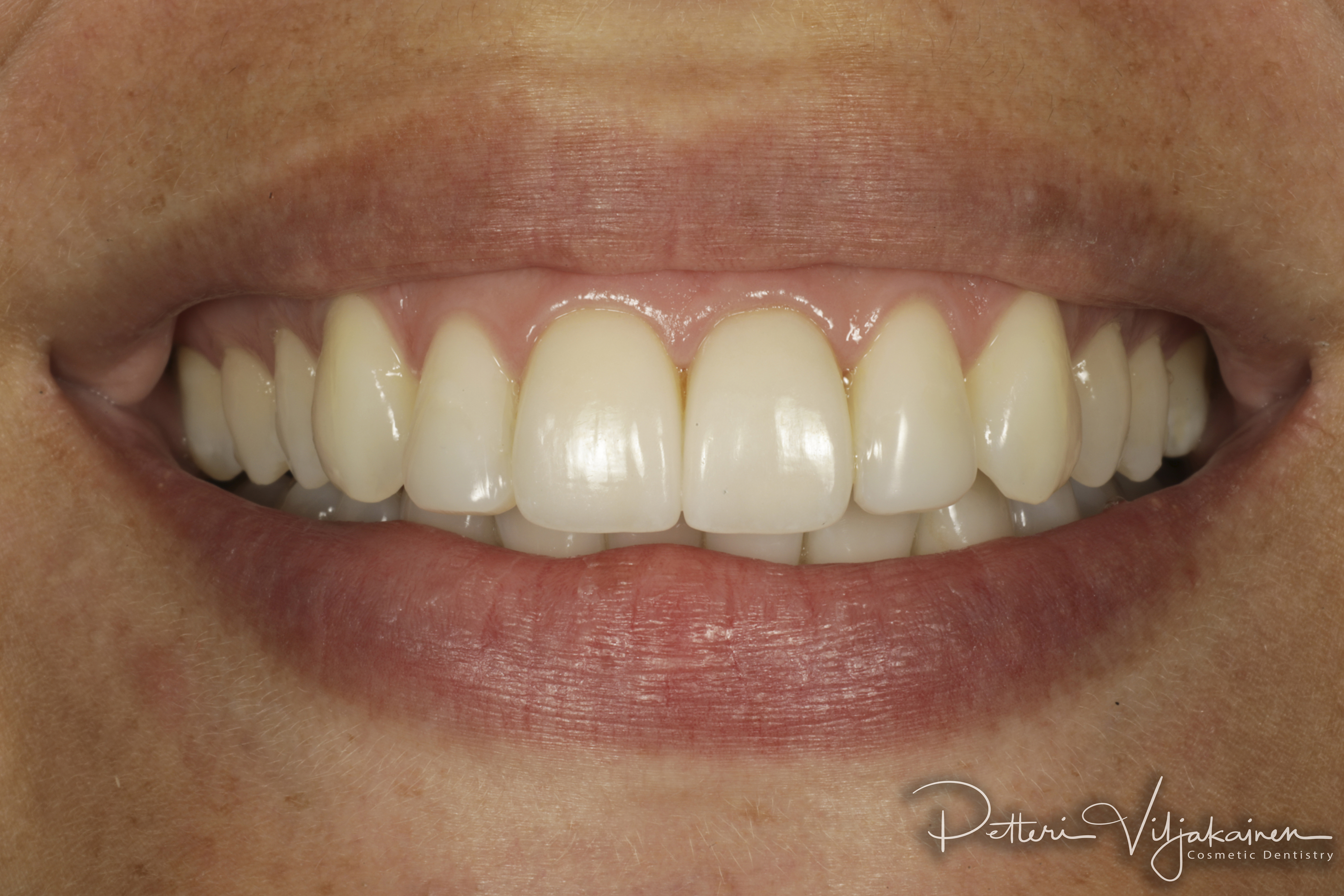 Invisalign oikomishoito tilanne oikomisen jälkeen. Keraamiset kuoret. Esteettiset kerrostusmuovit.
