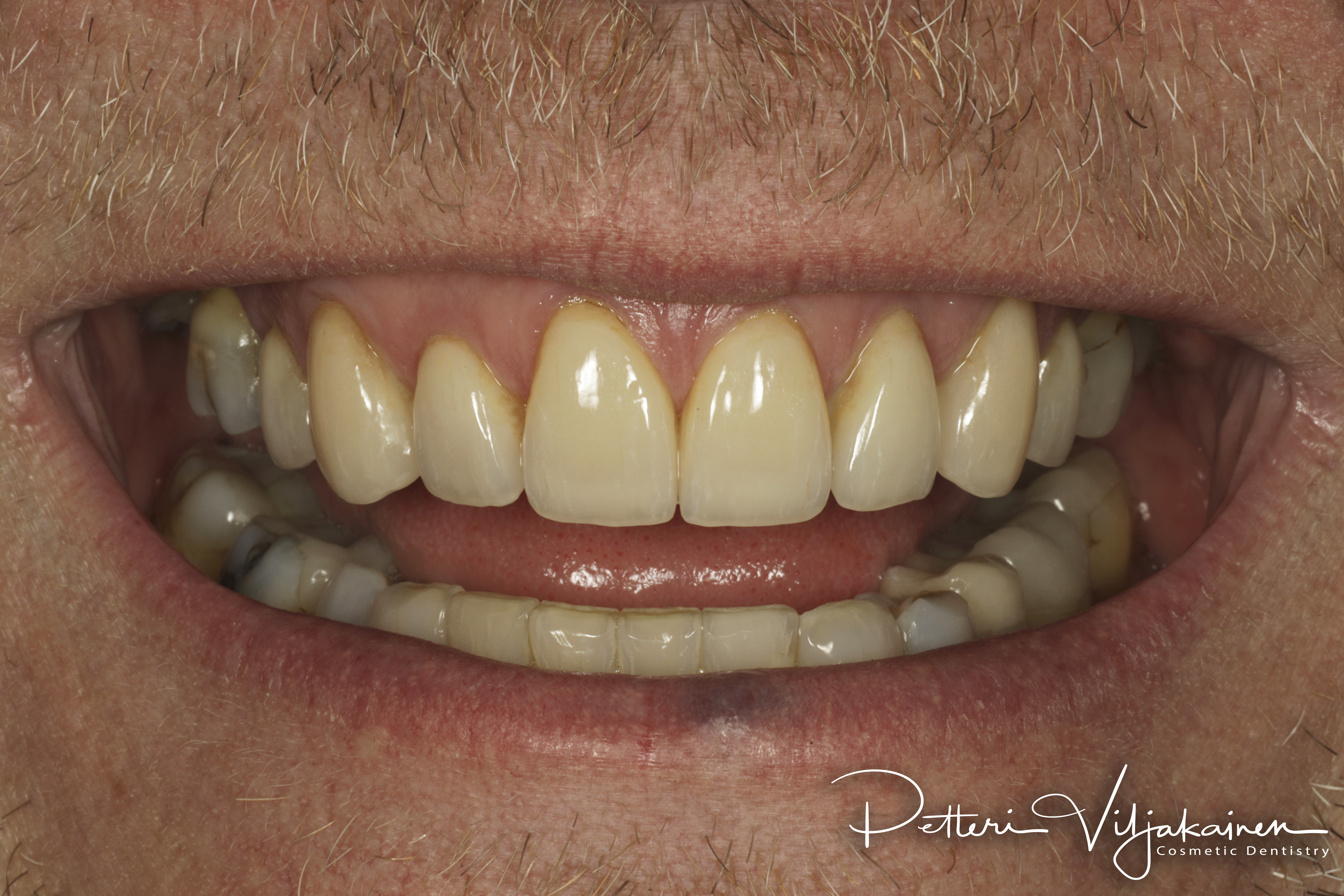 Invisalign oikomishoito jälkeen. Kahdeksaan yläetuhampaaseen tehtiin keraamiset kuoret eli hammaslaminaatit.
