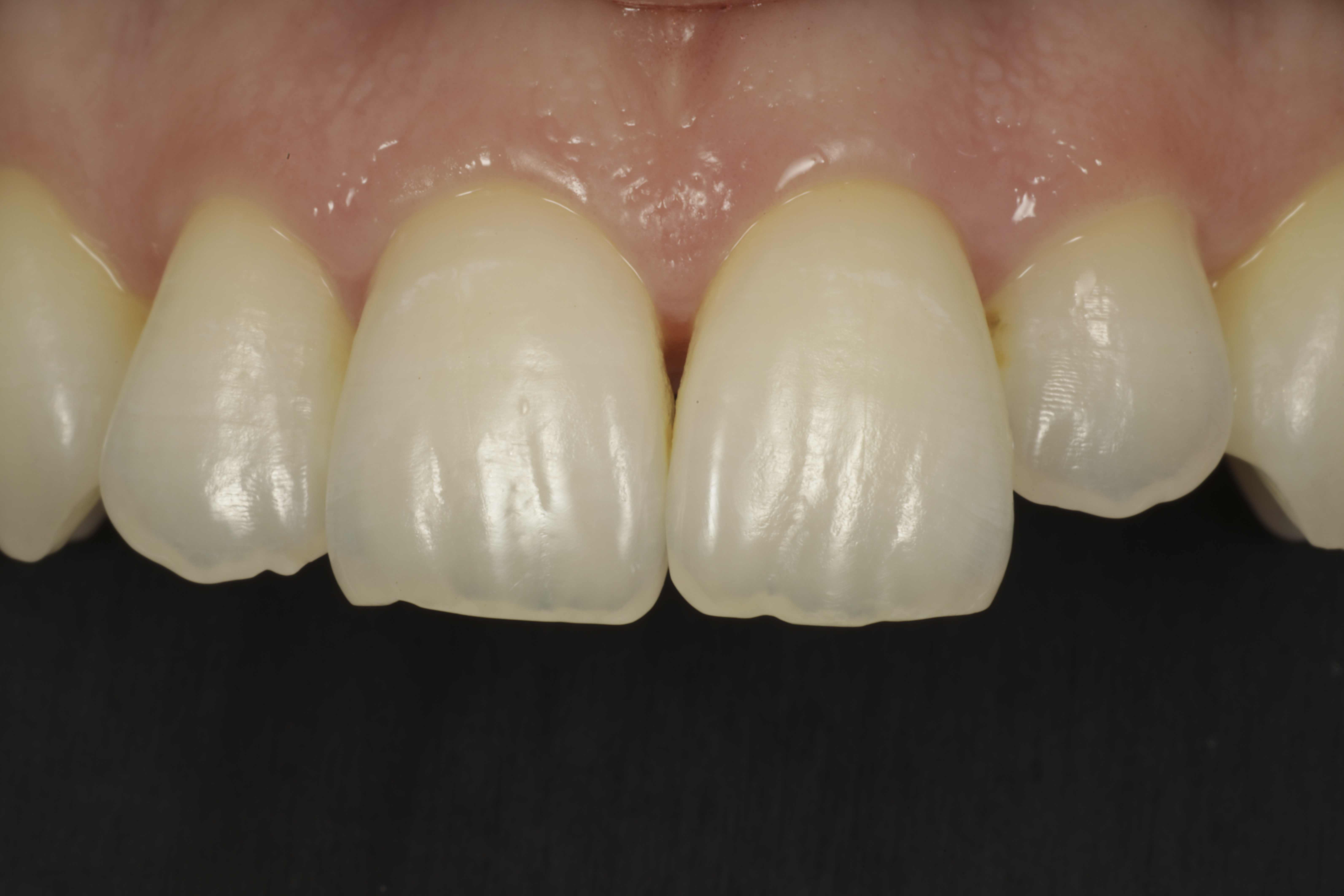 Invisalign oikomishoito ennen.