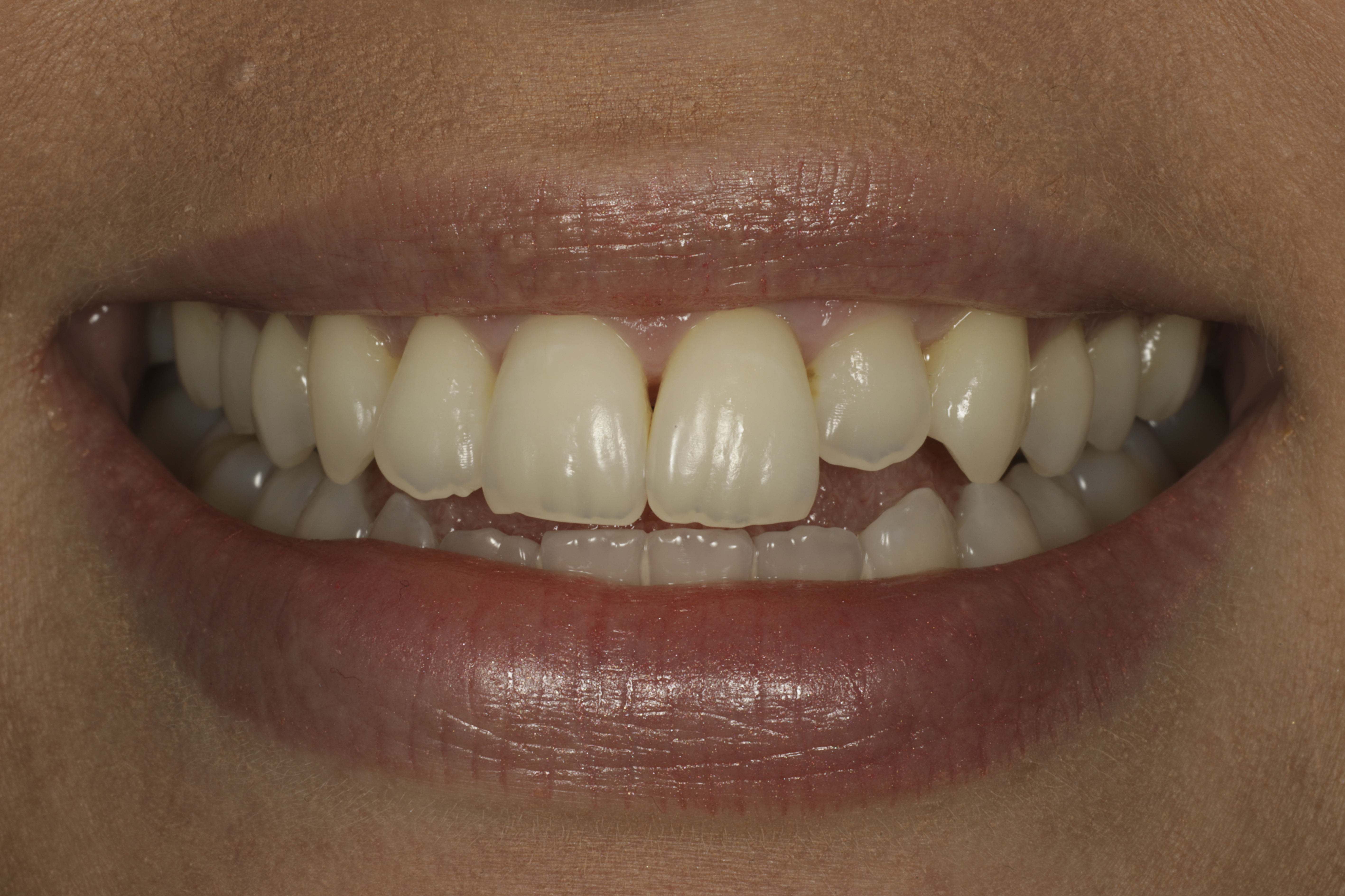 Invisalign oikomishoito ennen.