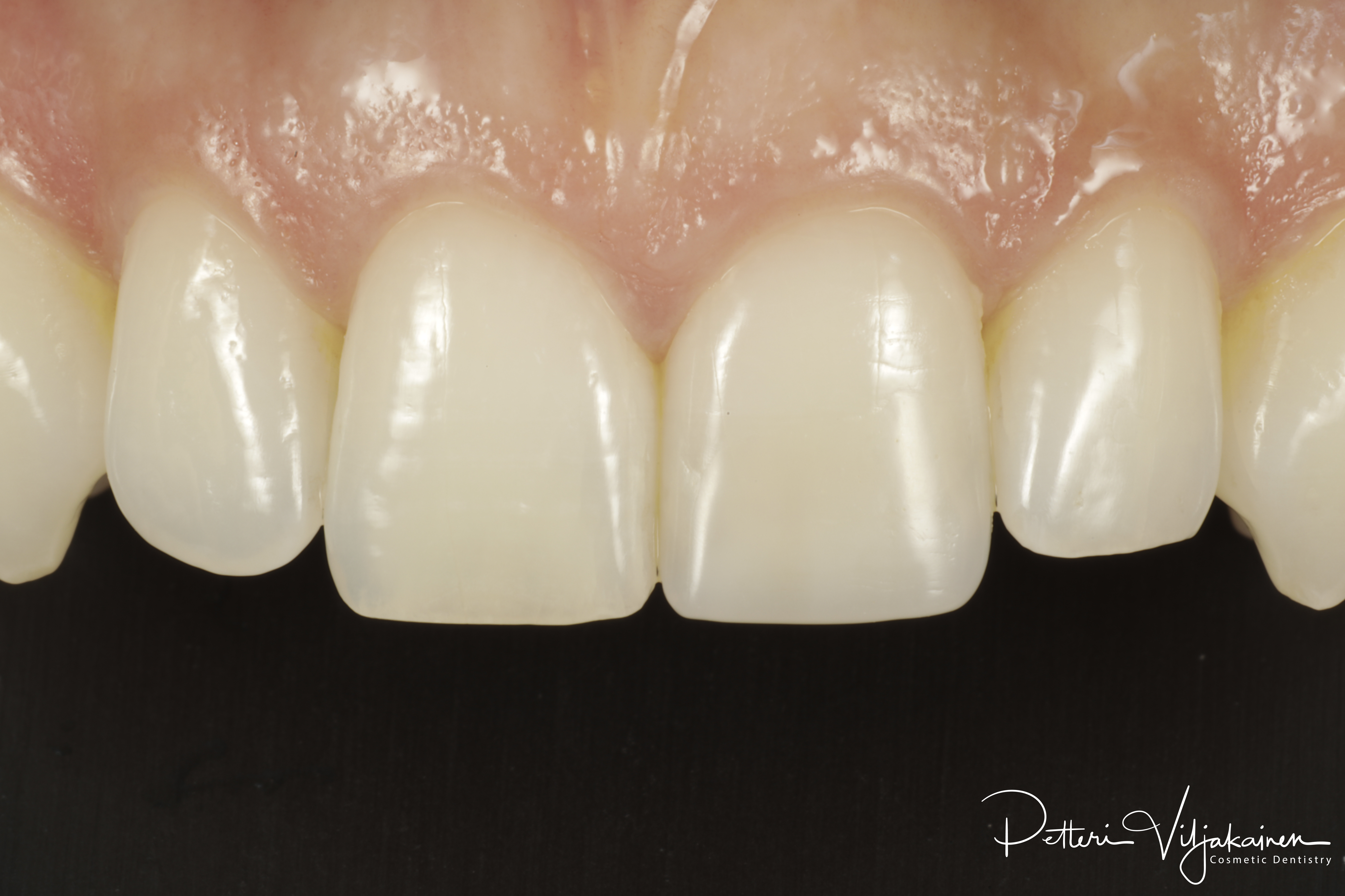 Esteettiset yhdistelmämuovitäytteet kerrostustekniikalla toteutettuna.