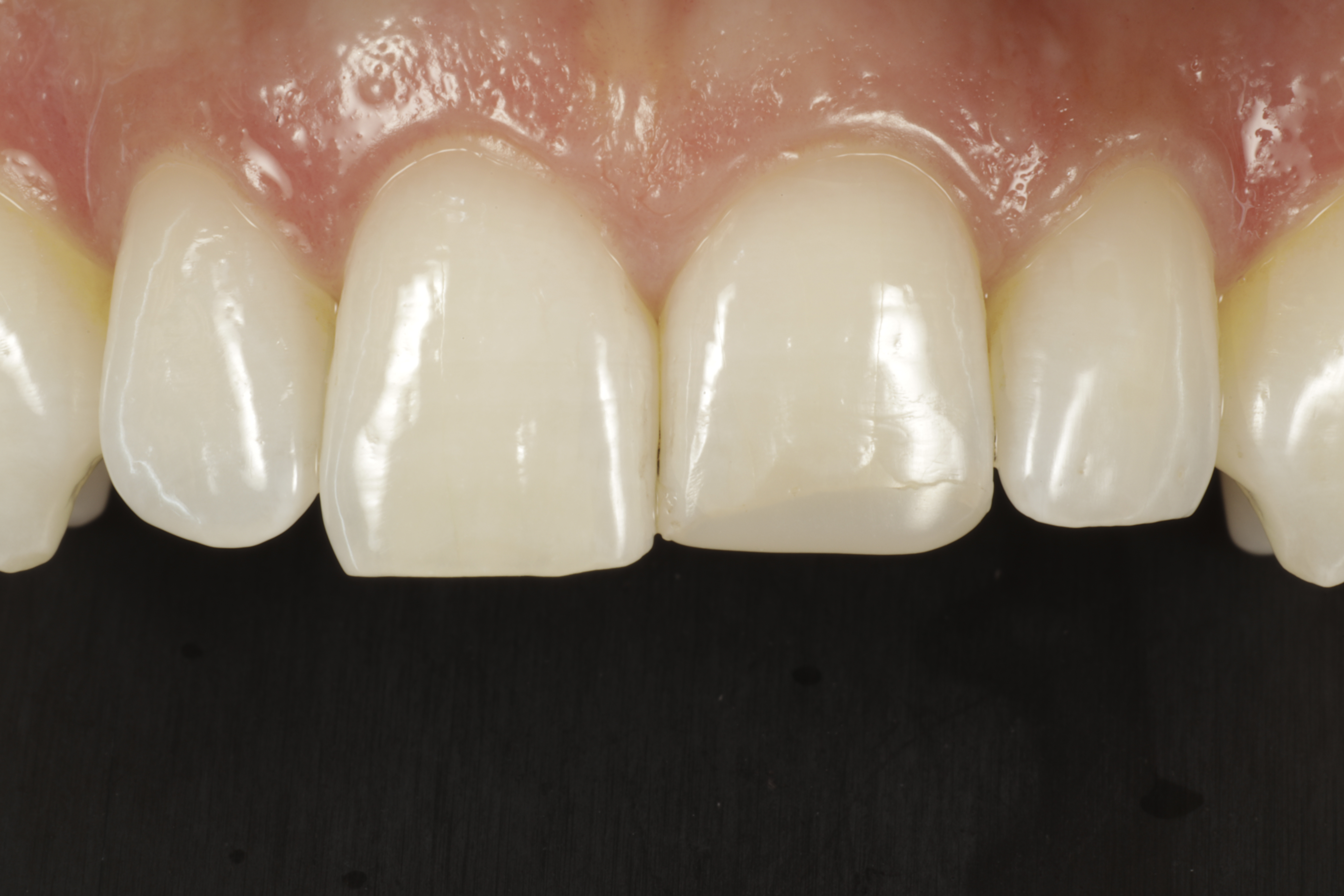 Invisalign oikomishoito ennen. 