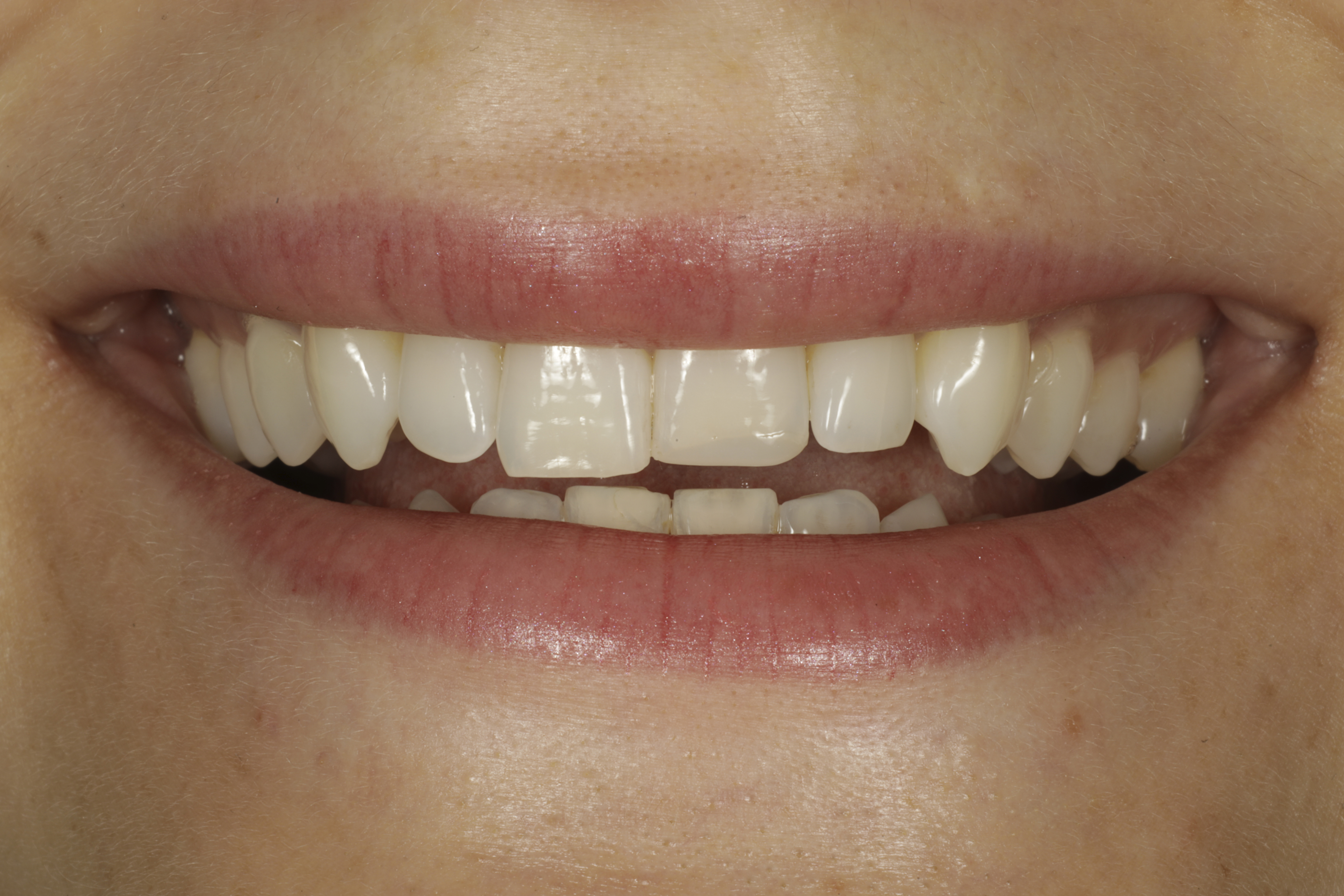 Invisalign oikomishoito ennen.