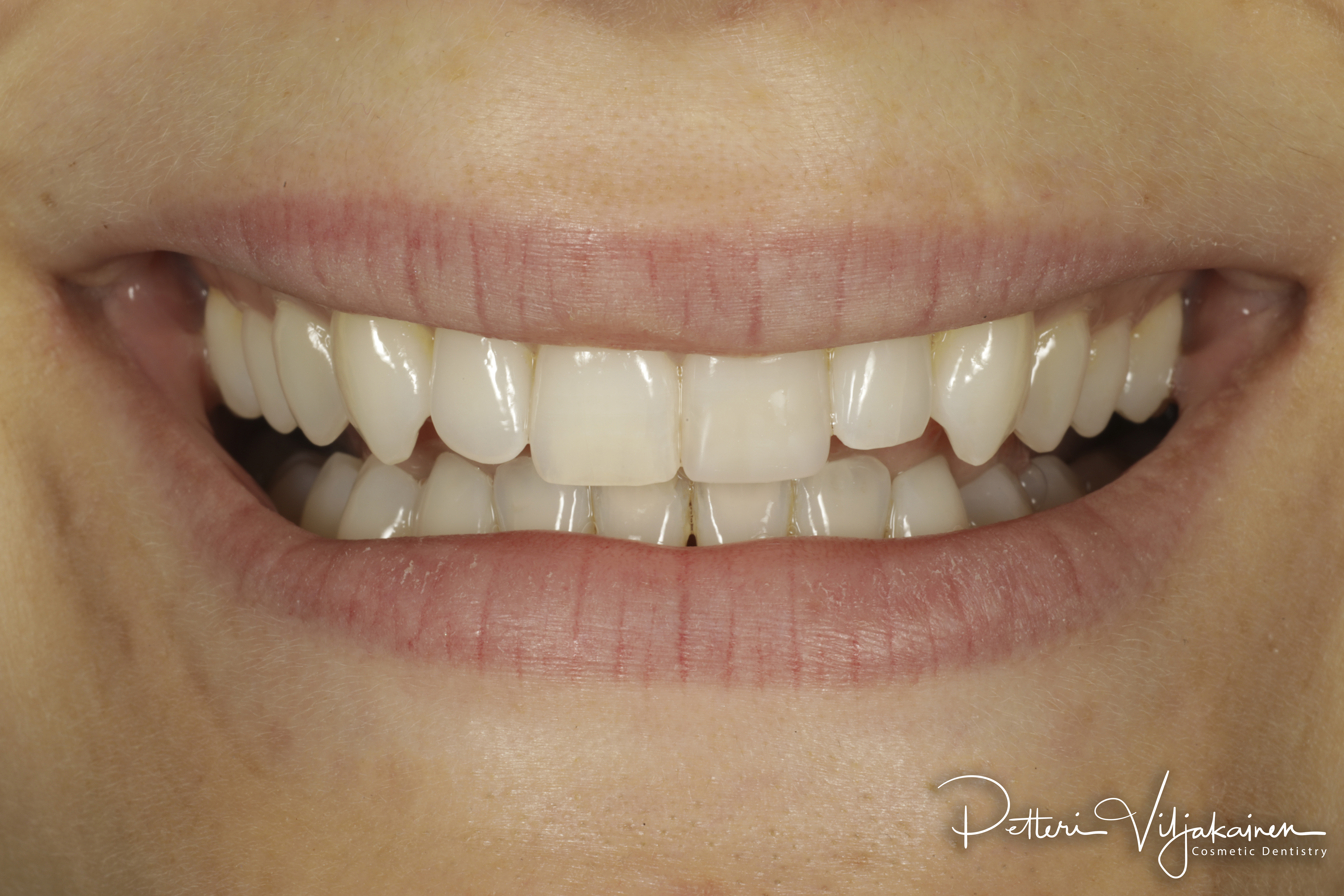 Invisalign oikomishoito jälkeen. Hoidon jälkeen toisen etuhampaan paikka uusittiin yhdistelmämuovitäytteellä kerrostustekniikalla.
