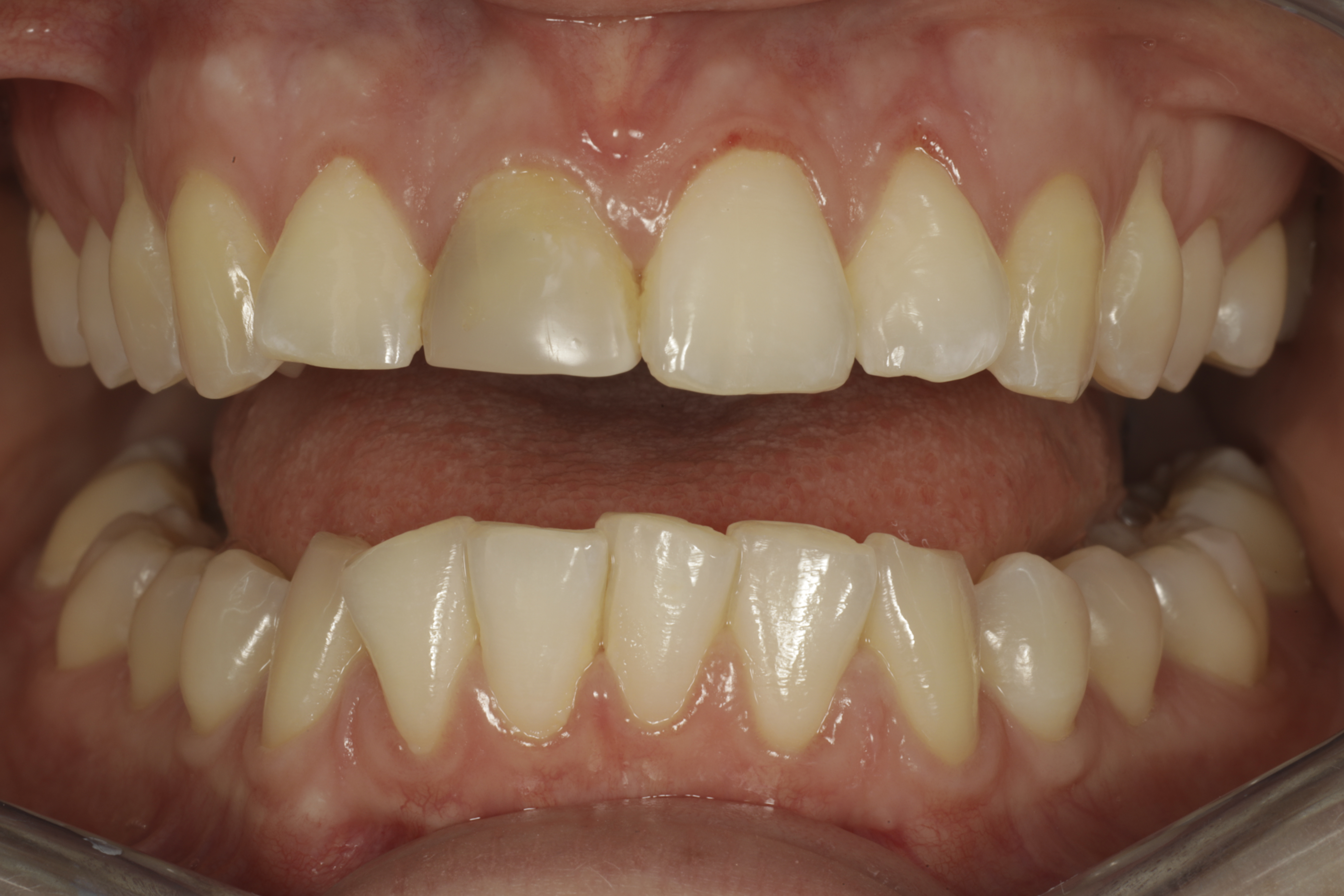 Invisalign oikomishoito ennen