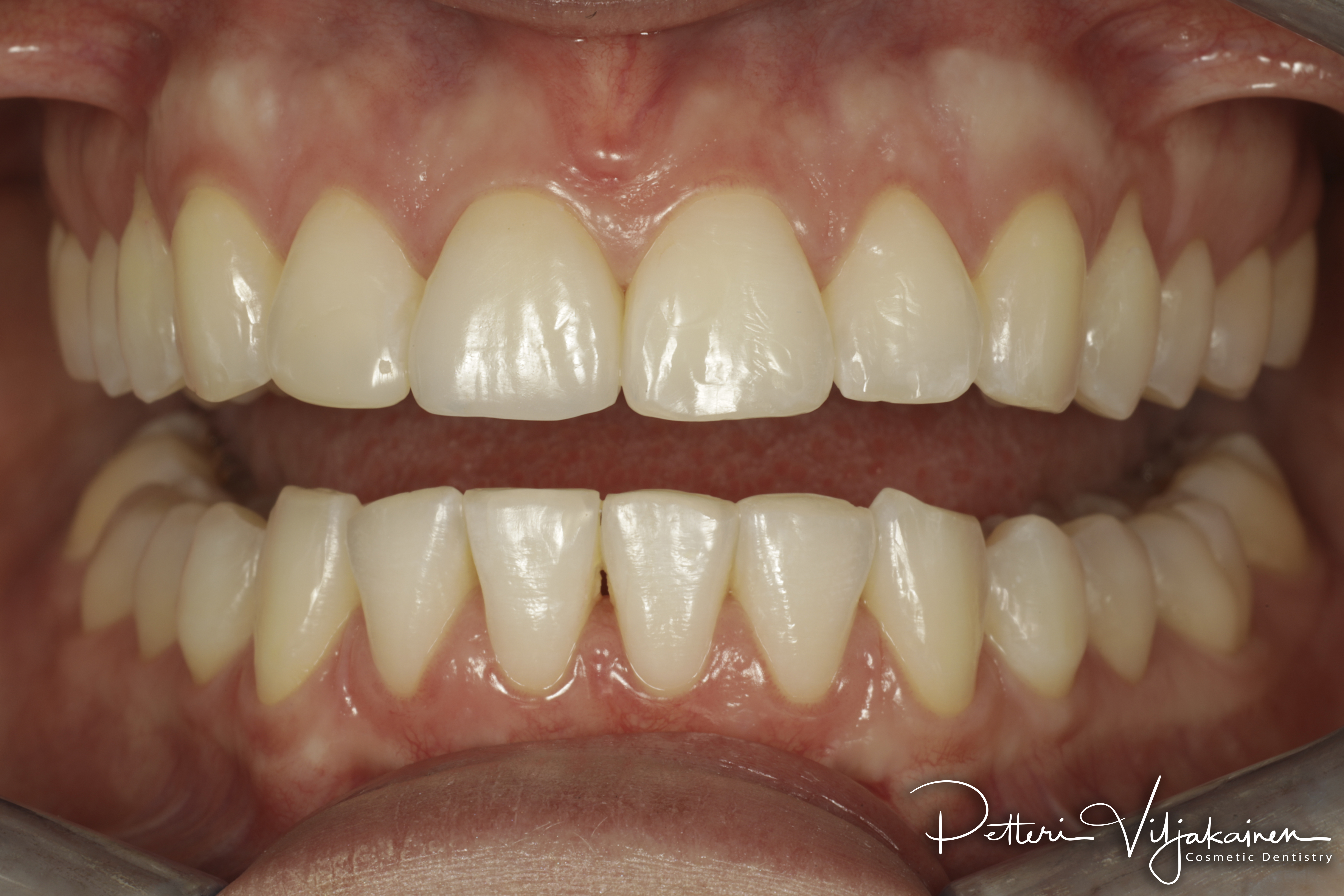 Invisalign oikomishoito jälkeen. Yksittäinen keraaminen kuori eli hammaslaminaatti tapaturmaisesti juurihoidettuun etuhampaaseen.
