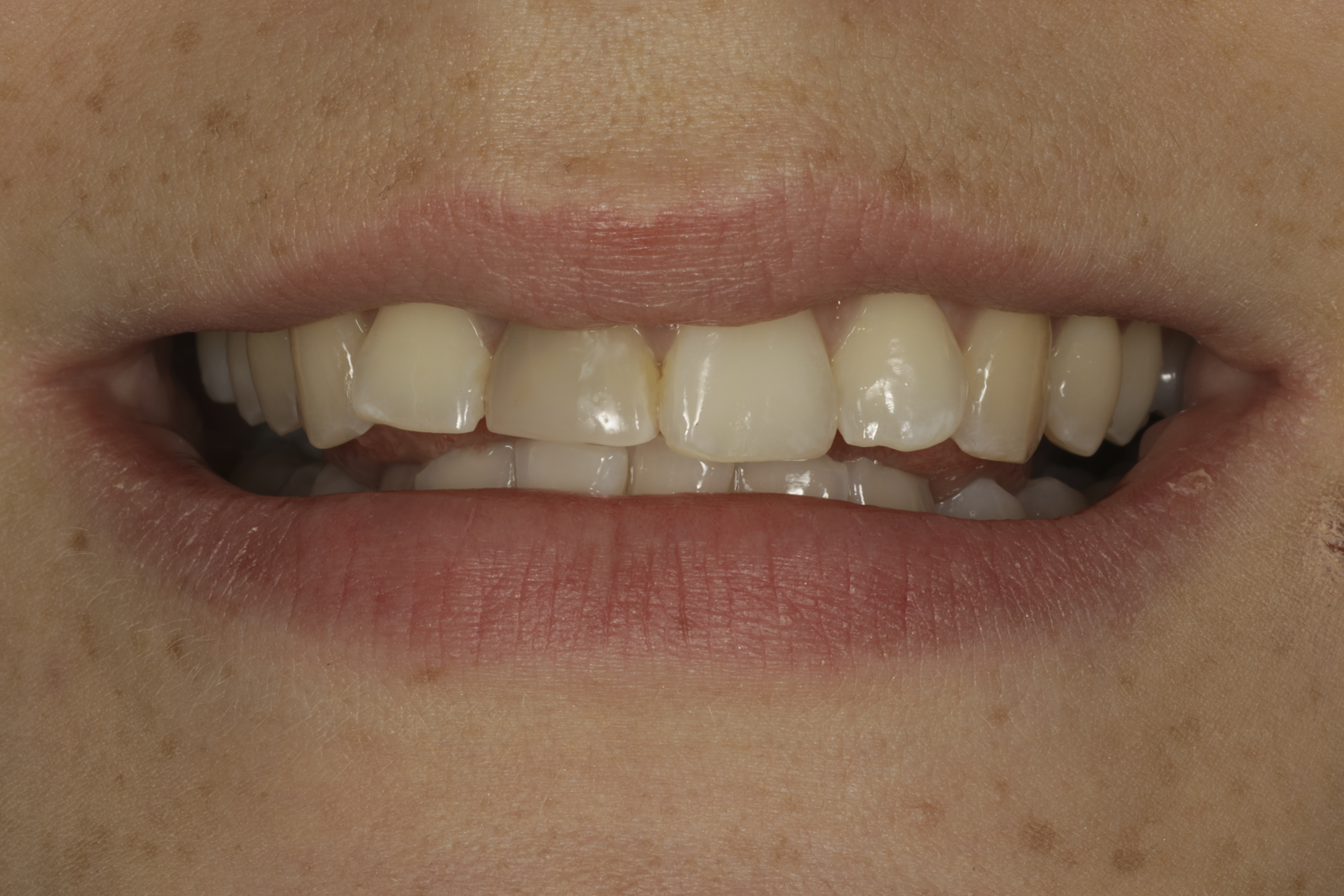 Invisalign oikomishoito ennen