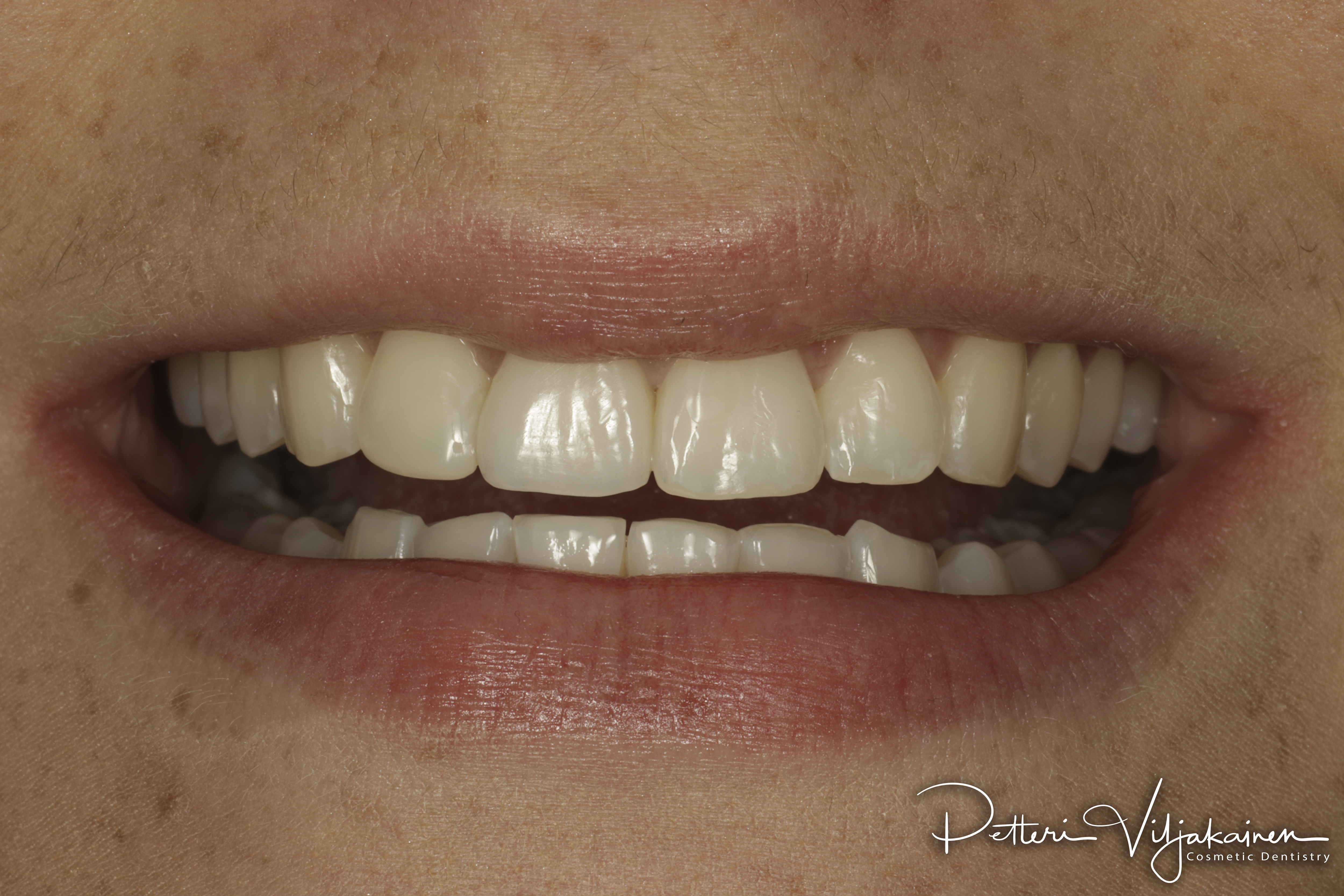 Invisalign oikomishoito jälkeen. Yksittäinen keraaminen kuori eli hammaslaminaatti tapaturmaisesti juurihoidettuun etuhampaaseen.